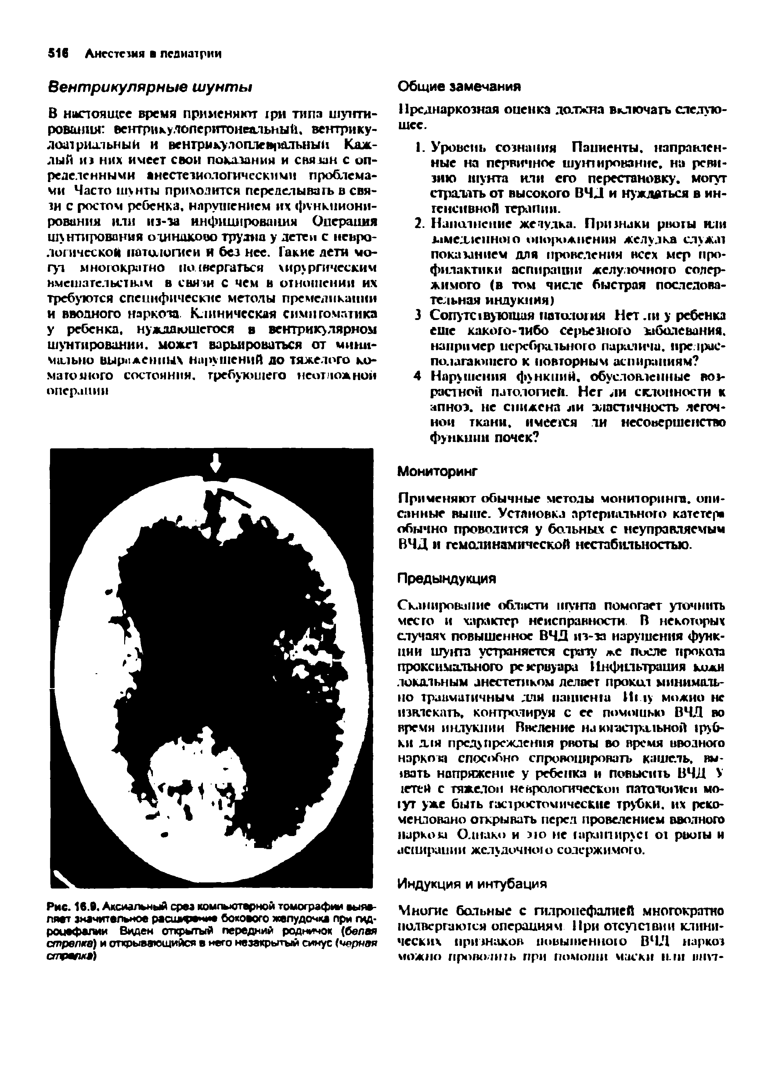 Рис. 16.В. Аксиальный срез компьютерной томографии выявляет значительное расширение бокового желудочка при гидроцефалии Виден открытый передний родничок (белая стрелка) и открывающийся в него незакрытый синус (черная стрем )...