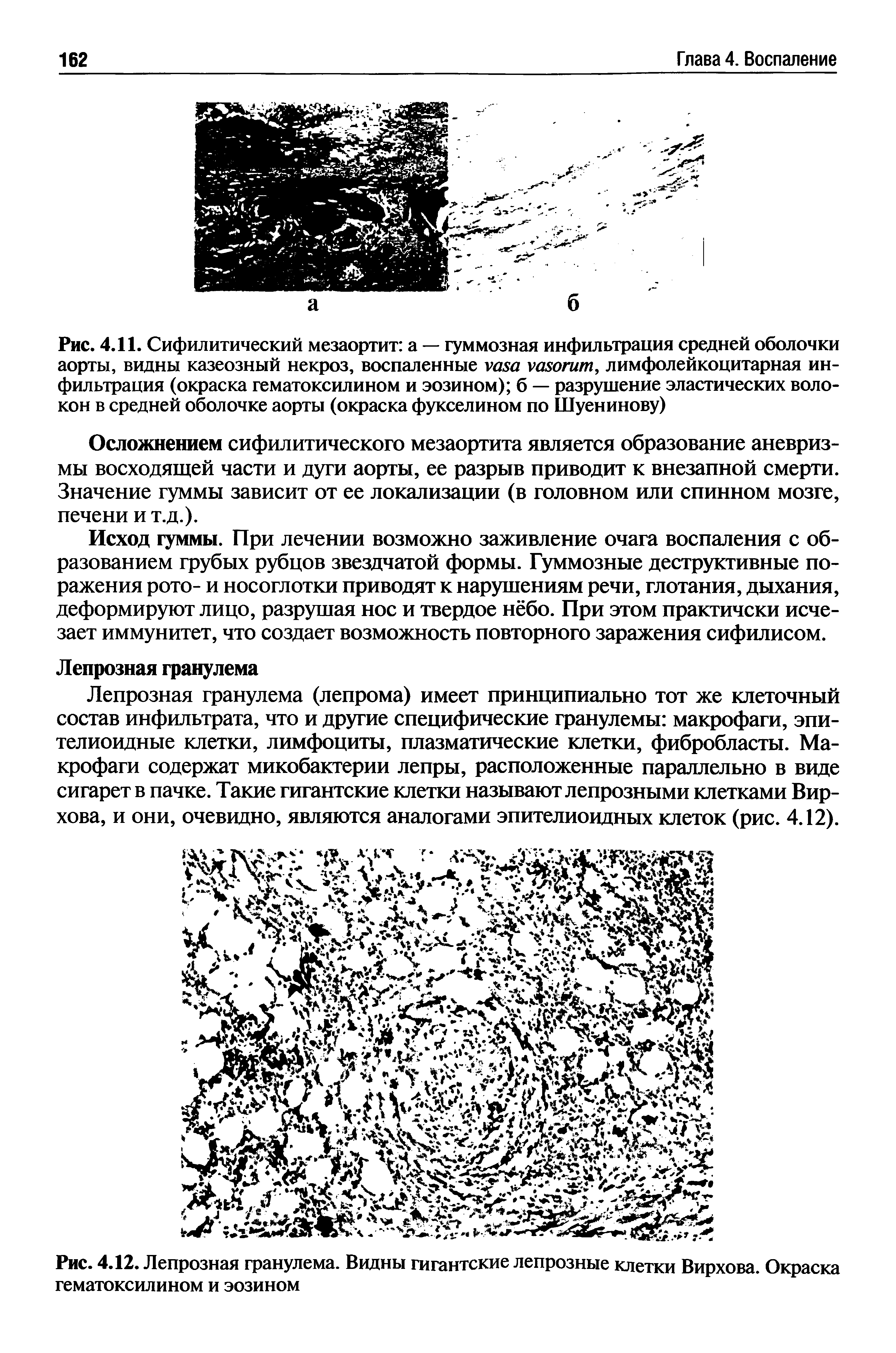 Рис. 4.12. Лепрозная гранулема. Видны гигантские лепрозные клетки Вирхова. Окраска гематоксилином и эозином...