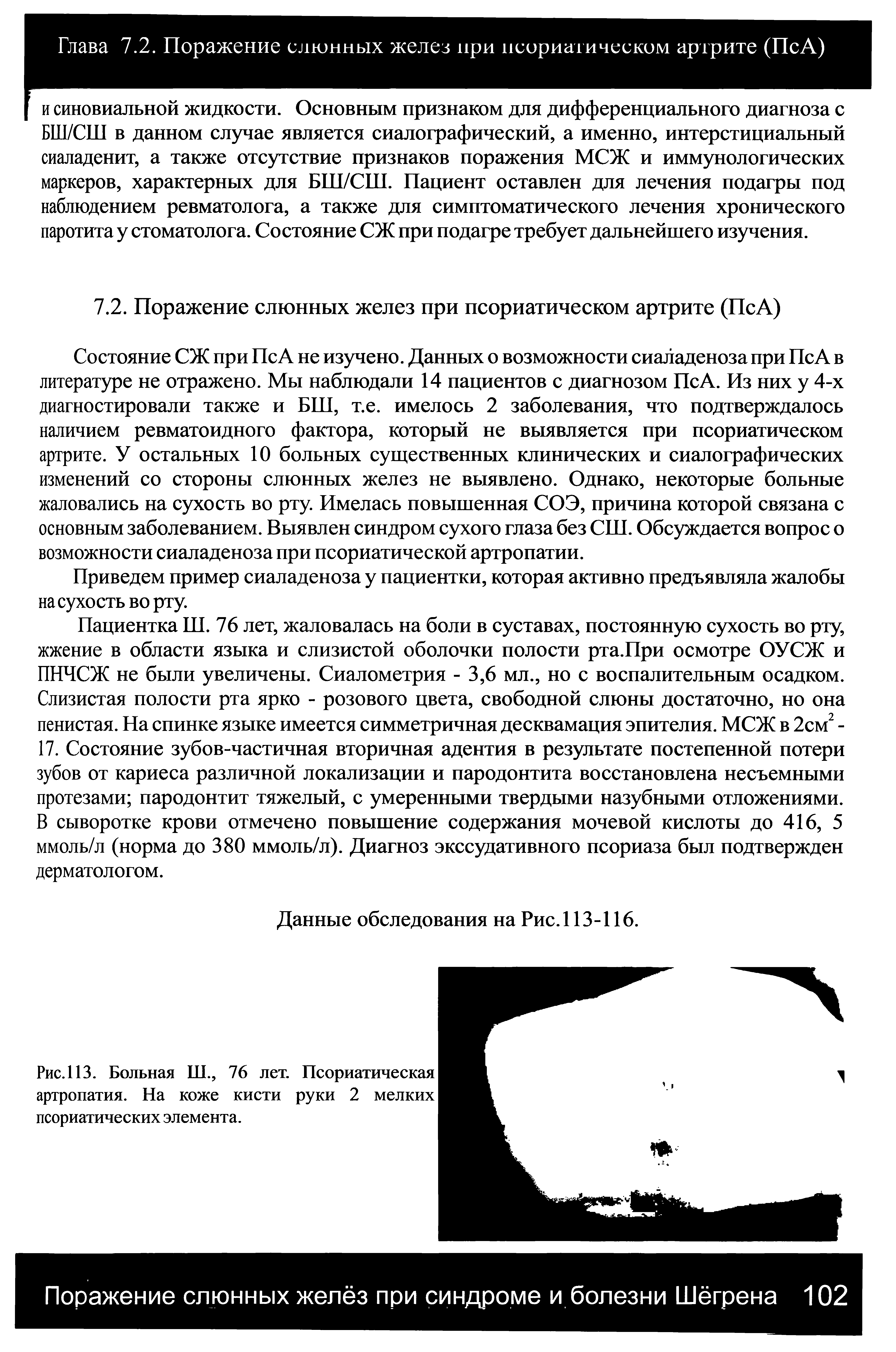 Рис. 113. Больная Ш., 76 лет. Псориатическая артропатия. На коже кисти руки 2 мелких псориатических элемента.