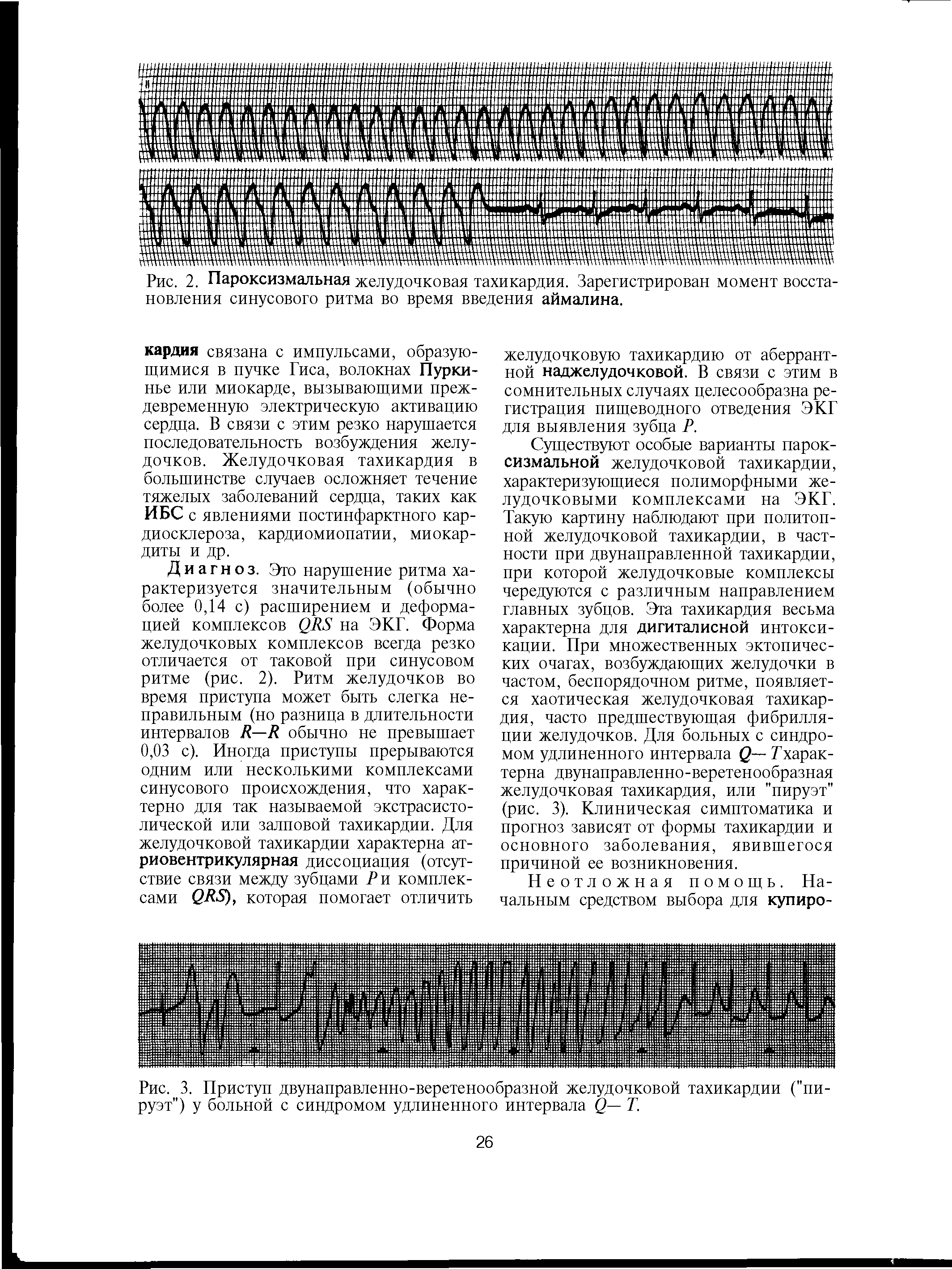 Рис. 3. Приступ двунаправленно-веретенообразной желудочковой тахикардии ("пируэт") у больной с синдромом удлиненного интервала 2— Т.