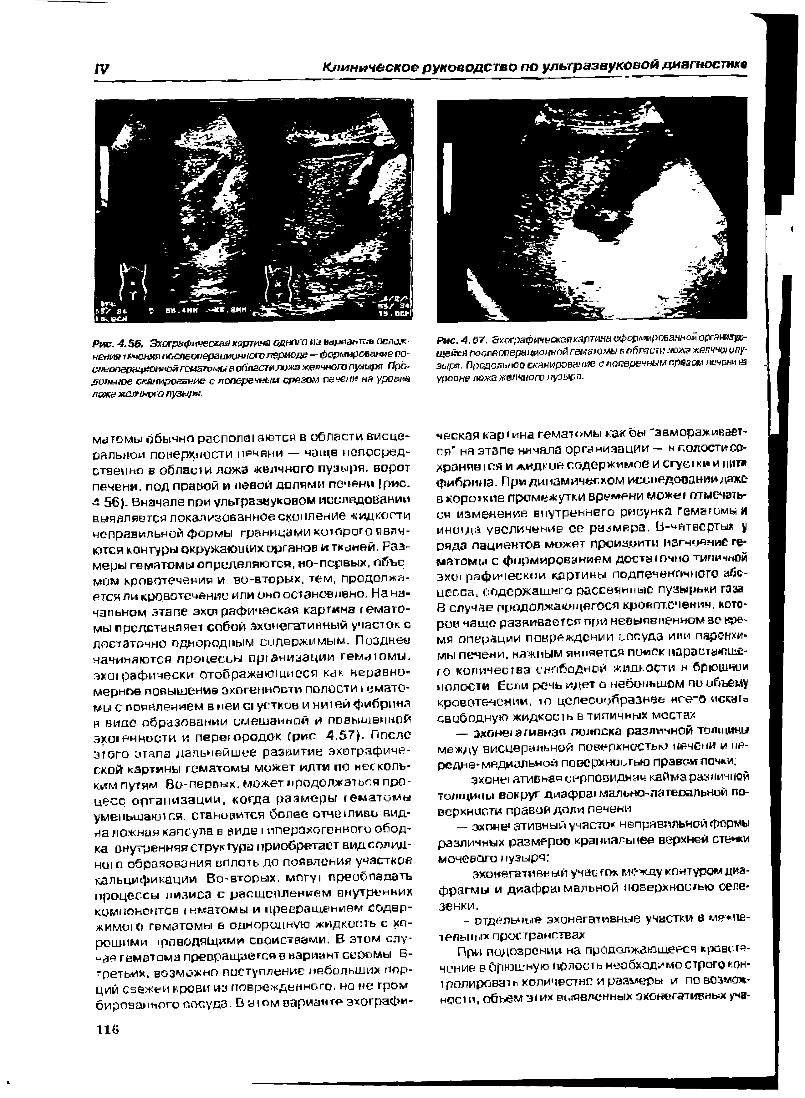 Рис. 4.67. Эк< г эяфическнякартина у ормироЕаннеи опгяи(иук- HH /нпй гем > омы в л б лас г и лож же изд о пузыря. Предельное сканирование с поперечным срезом леченн чз уровне ложа желчного пузыр.п.