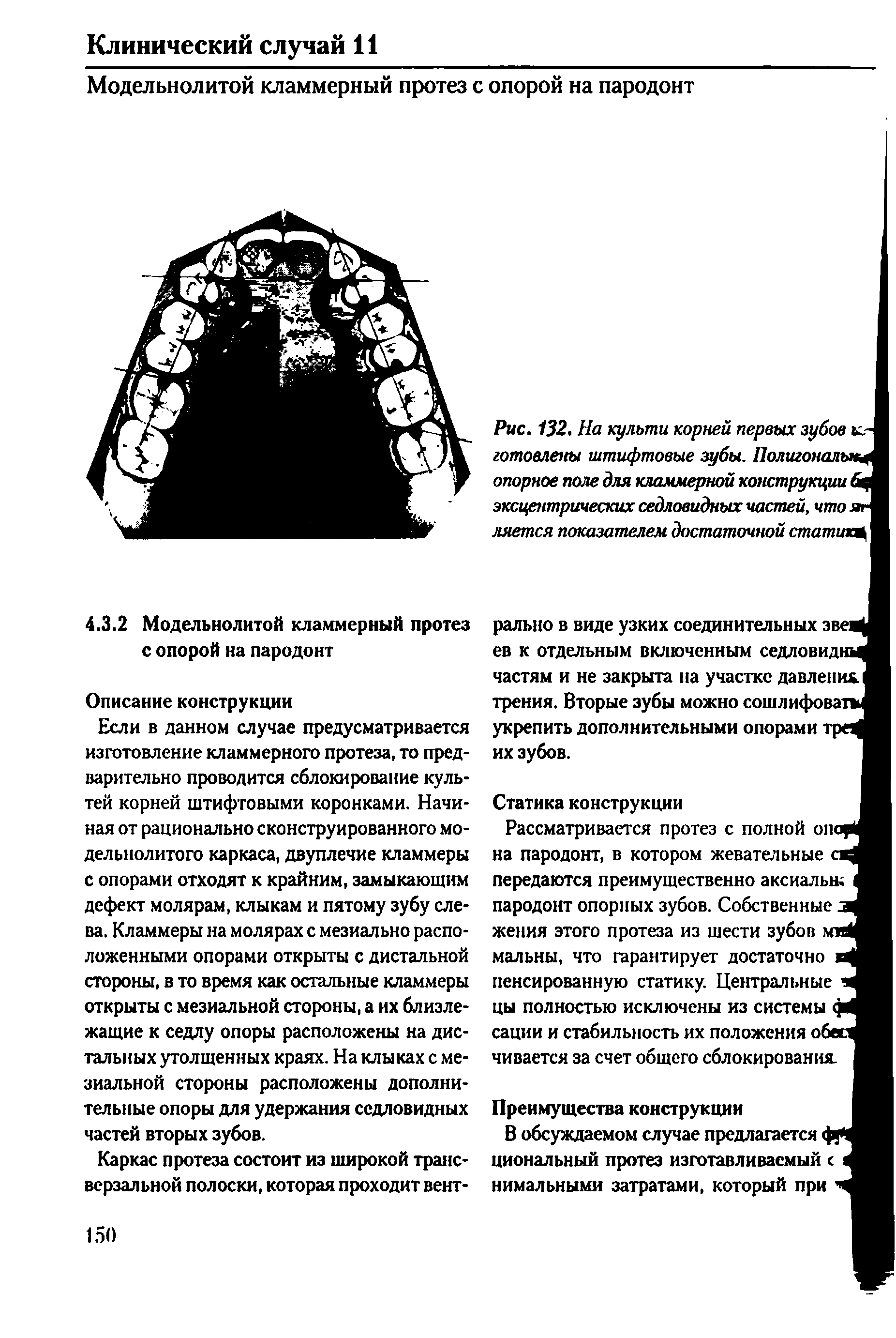 Рис. 132. На культи корней первых зубов и-готовлены штифтовые зубы. Полигональна опорное поле для кламмерной конструкции 6 эксцентрических седловидных частей, что яг ляется показателем достаточной статику...