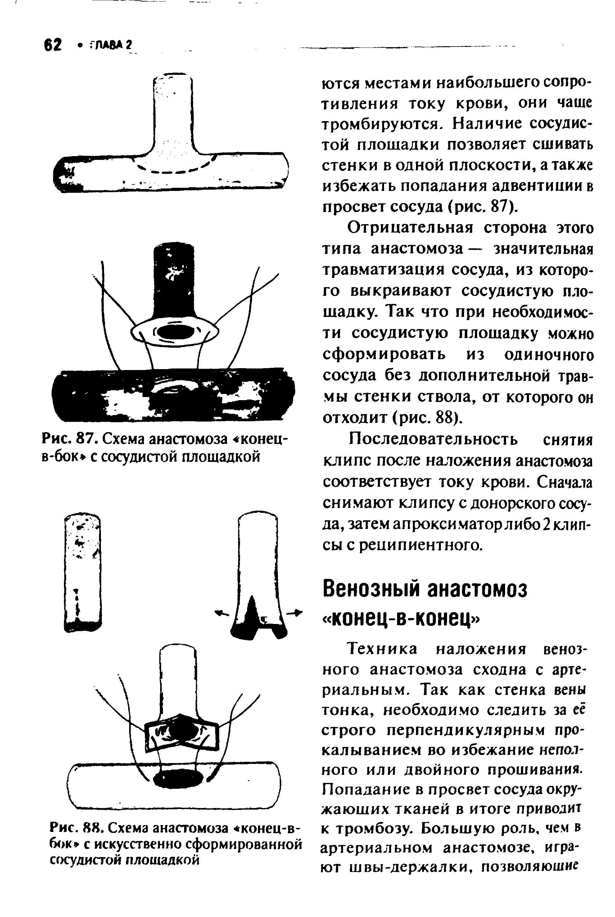 Рис. 88. Схема анастомоза конец-в-бок с искусственно сформированной сосудистой площадкой...