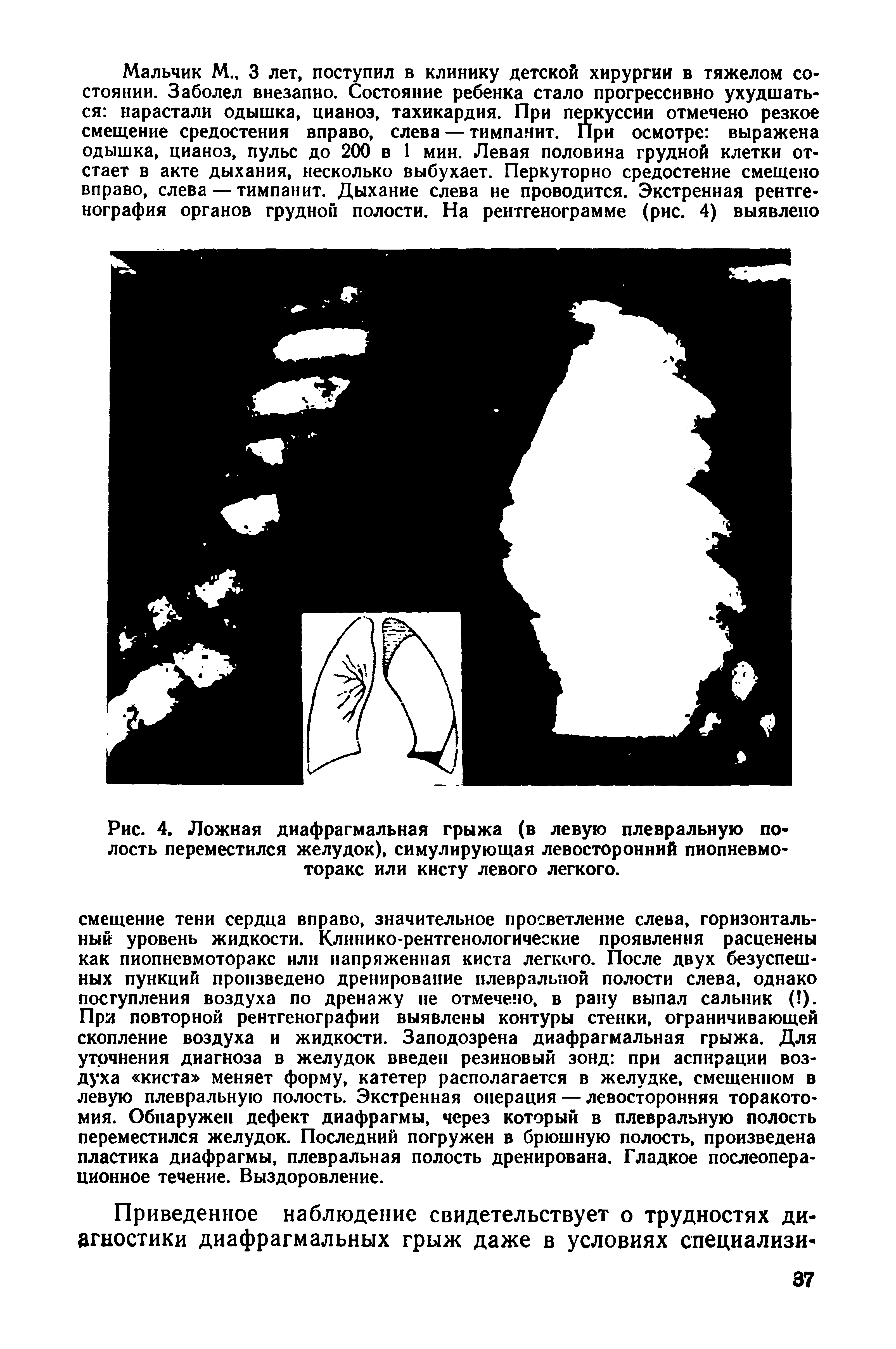 Рис. 4. Ложная диафрагмальная грыжа (в левую плевральную полость переместился желудок), симулирующая левосторонний пиопневмо-торакс или кисту левого легкого.