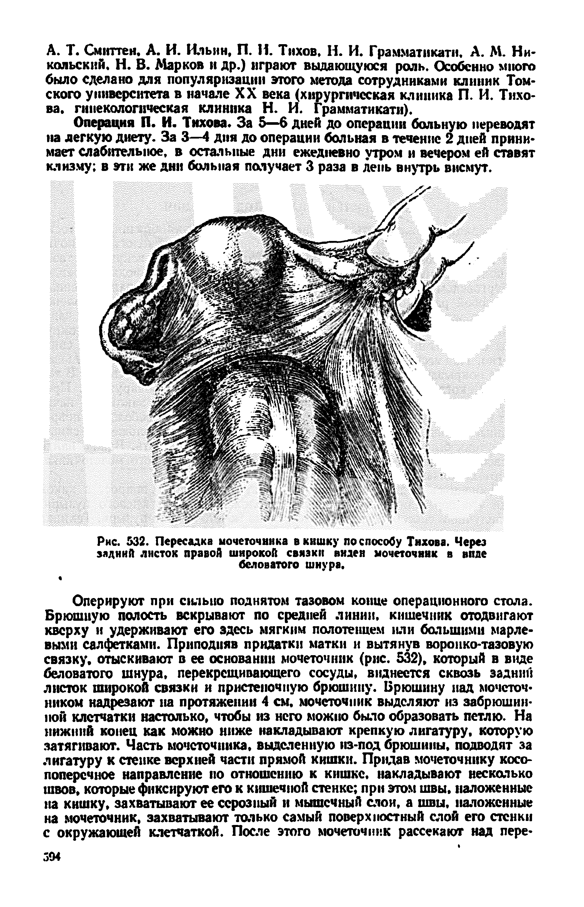 Рис. 532. Пересадка мочеточника в кишку по способу Тихова. Через задний листок правой широкой связки виден мочеточник в виде беловатого шнура.