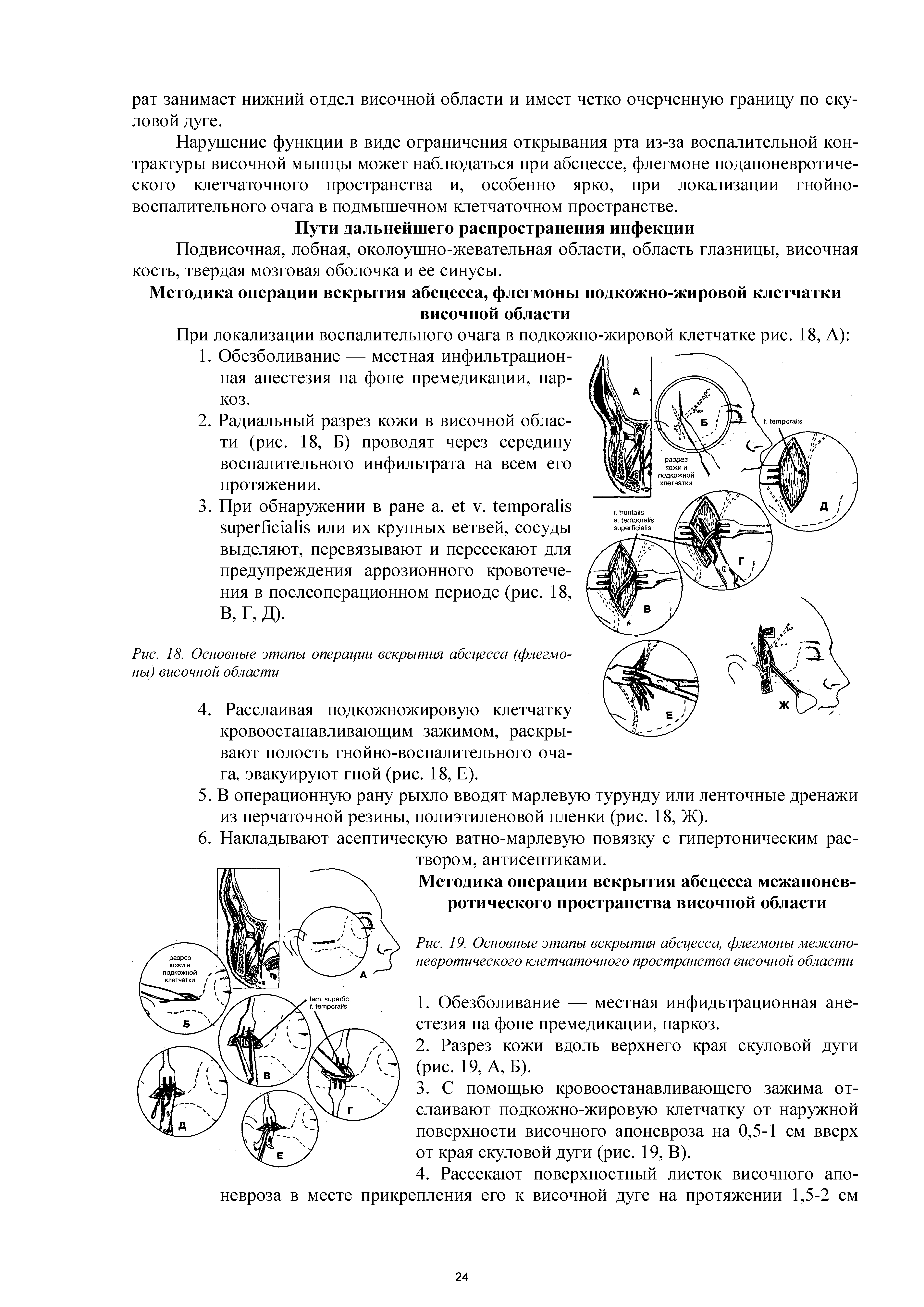 Рис. 19. Основные этапы вскрытия абсцесса, флегмоны межапоневротического клетчаточного пространства височной области...