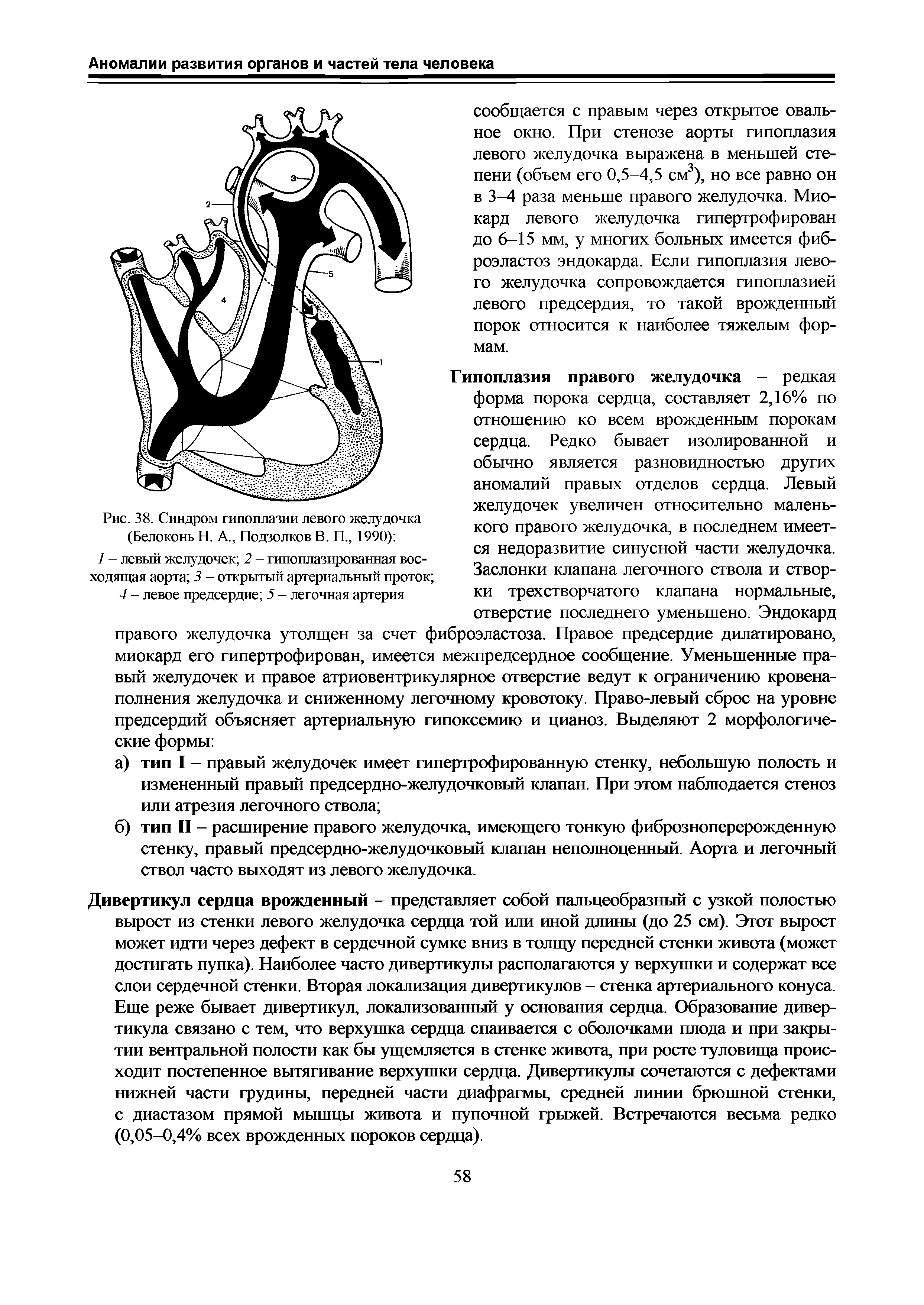 Рис. 38. Синдром гипоплазии левого желудочка (Белоконь Н. А., Подзолков В. П., 1990) ...