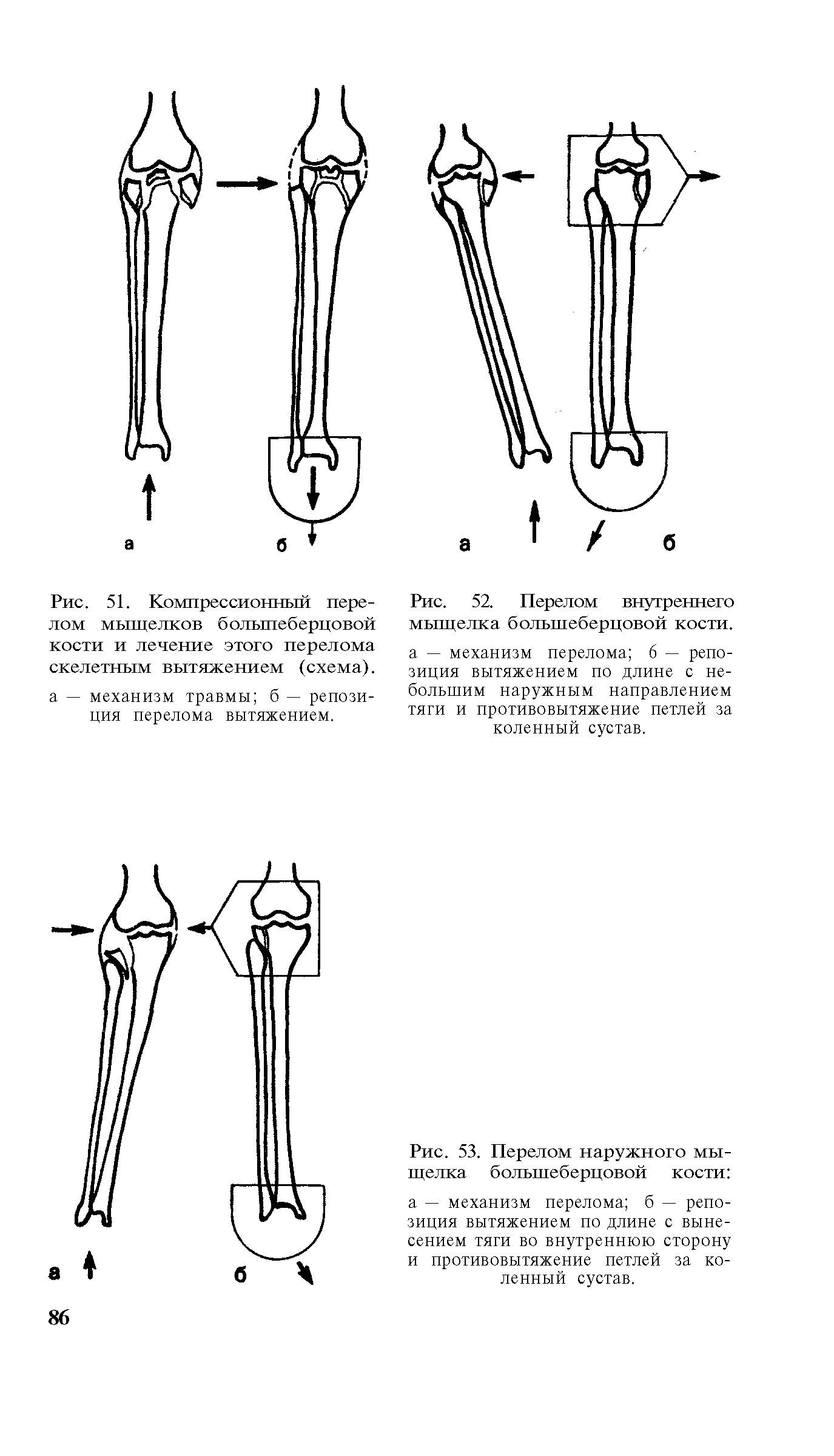 Рис. 52. Перелом внутреннего мыщелка большеберцовой кости, а — механизм перелома 6 — репозиция вытяжением по длине с не-болвшим наружным направлением тяги и противовытяжение петлей за коленный сустав.