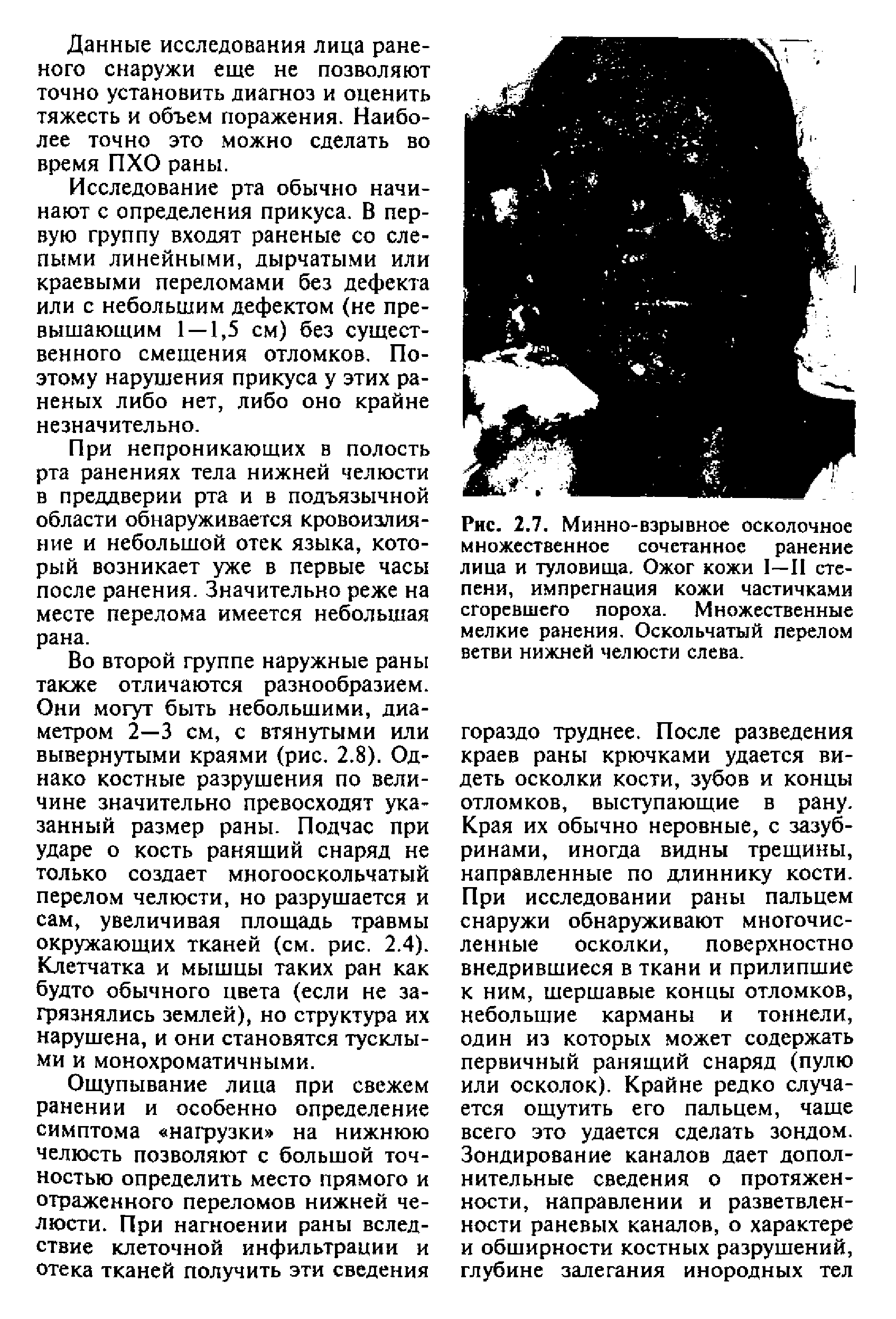 Рис. 2.7. Минно-взрывное осколочное множественное сочетанное ранение лица и туловища. Ожог кожи I—II степени, импрегнация кожи частичками сгоревшего пороха. Множественные мелкие ранения. Оскольчатый перелом ветви нижней челюсти слева.