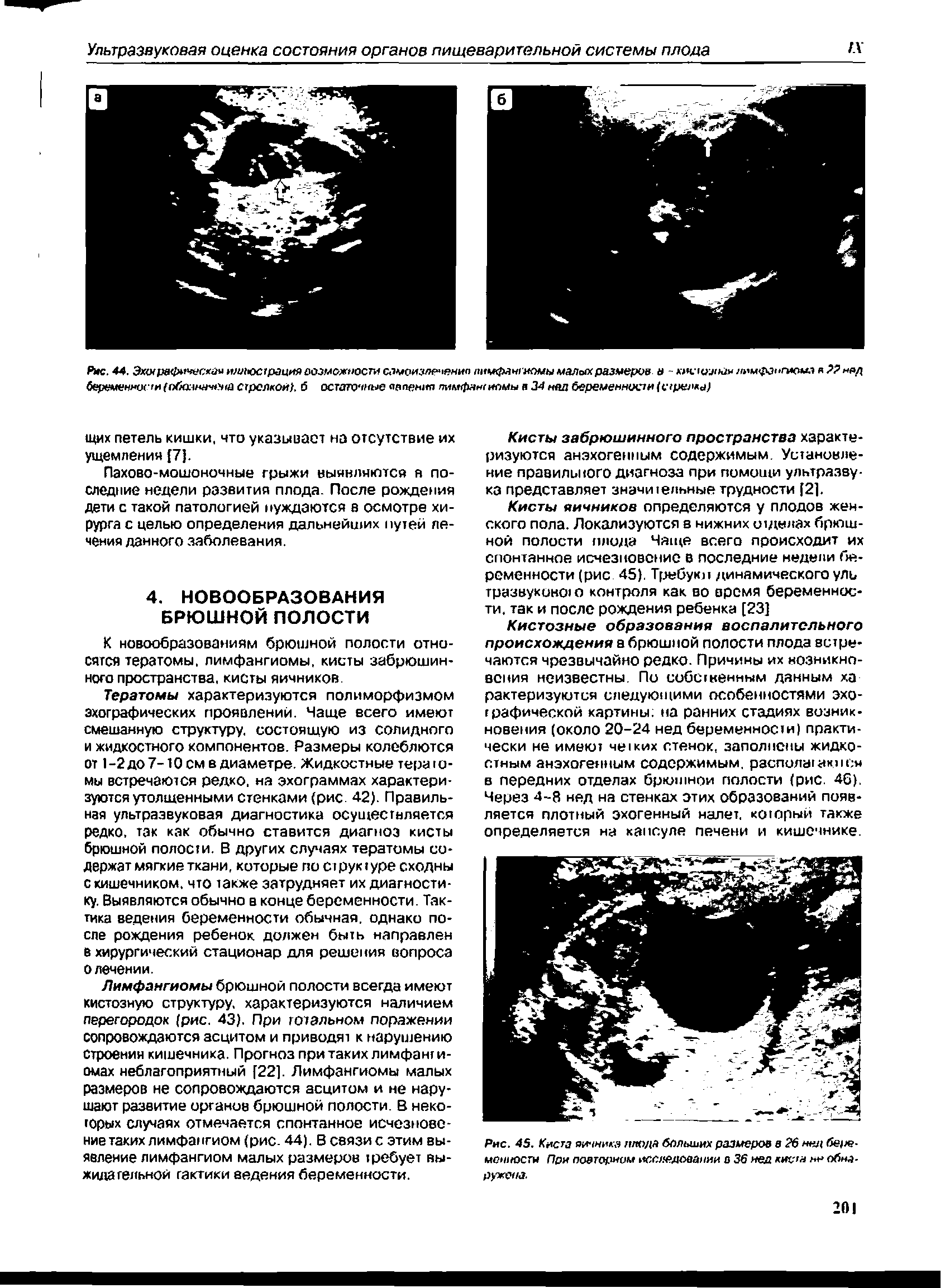 Рис. 45. Киста яичника плода больших размеров в 26 нед монносты При повторном исследовании о 36 нед кисн не обнаружена.