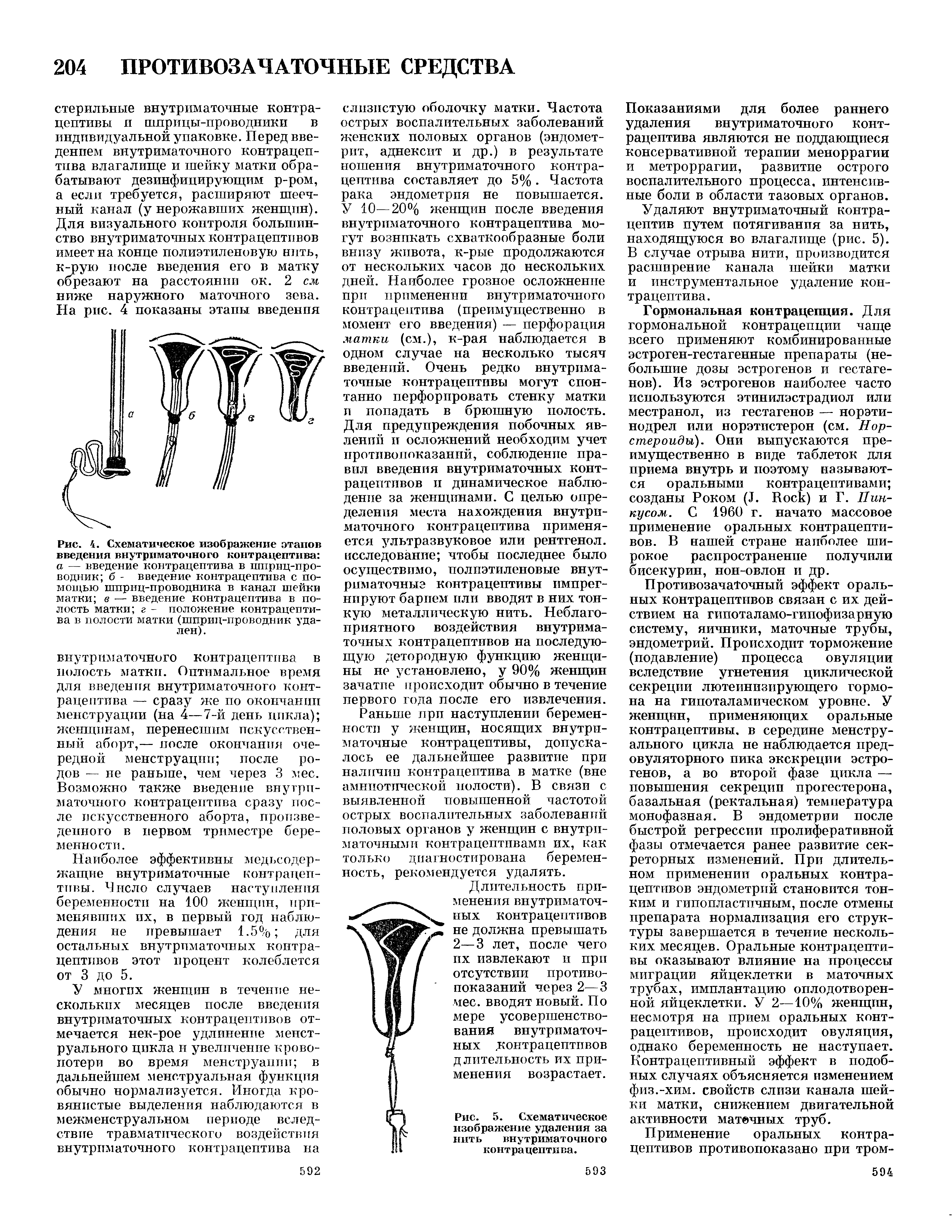 Рис. 4. Схематическое изображение этапов введения внутриматочного контрацептива а — введение контрацептива в шприц-проводник б - введение контрацептива с помощью шприц-проводника в канал шейки матки в — введение контрацептива в полость матки г - положение контрацептива в полости матки (шприц-проводник удален). ...