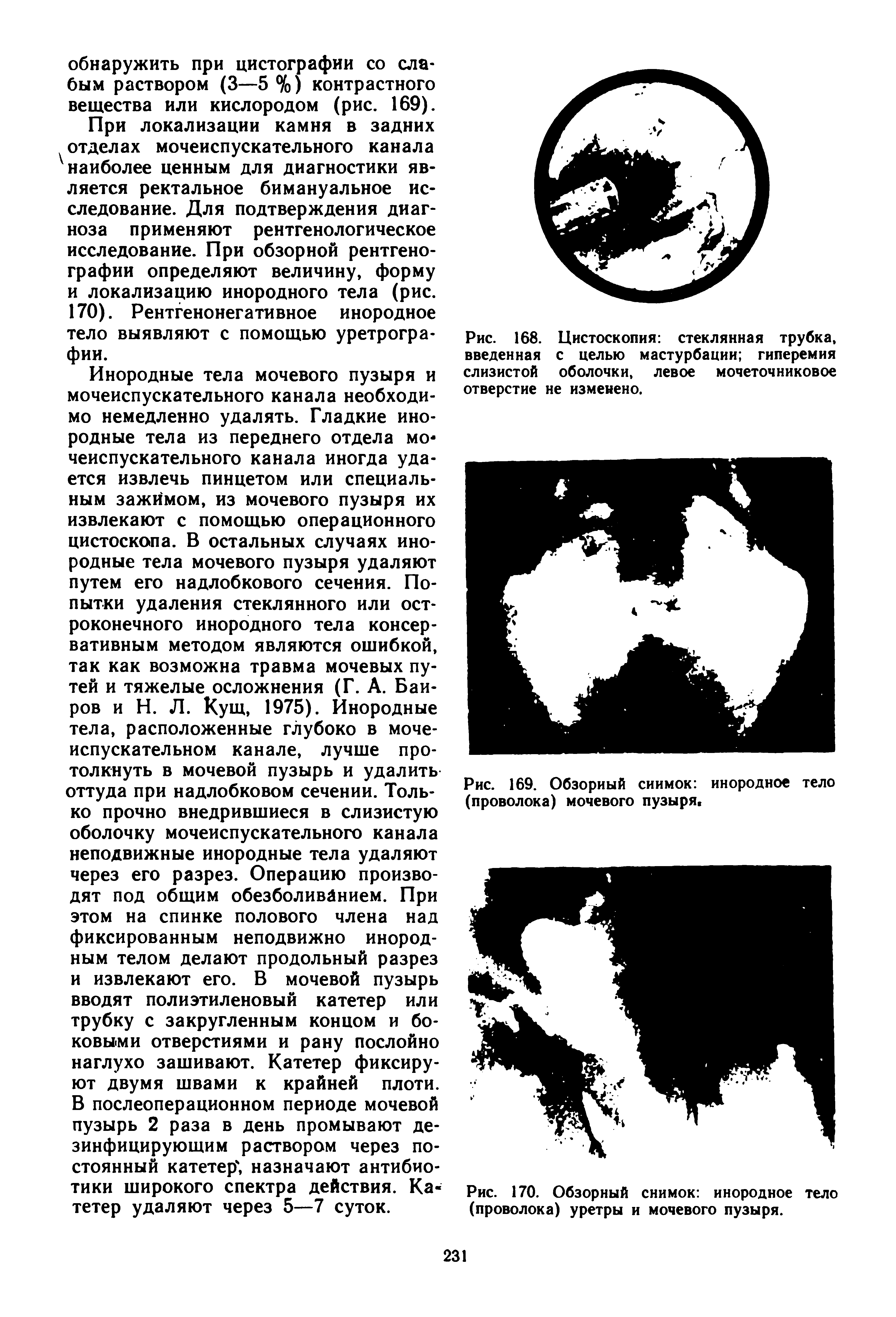 Рис. 170. Обзорный снимок инородное тело (проволока) уретры и мочевого пузыря.