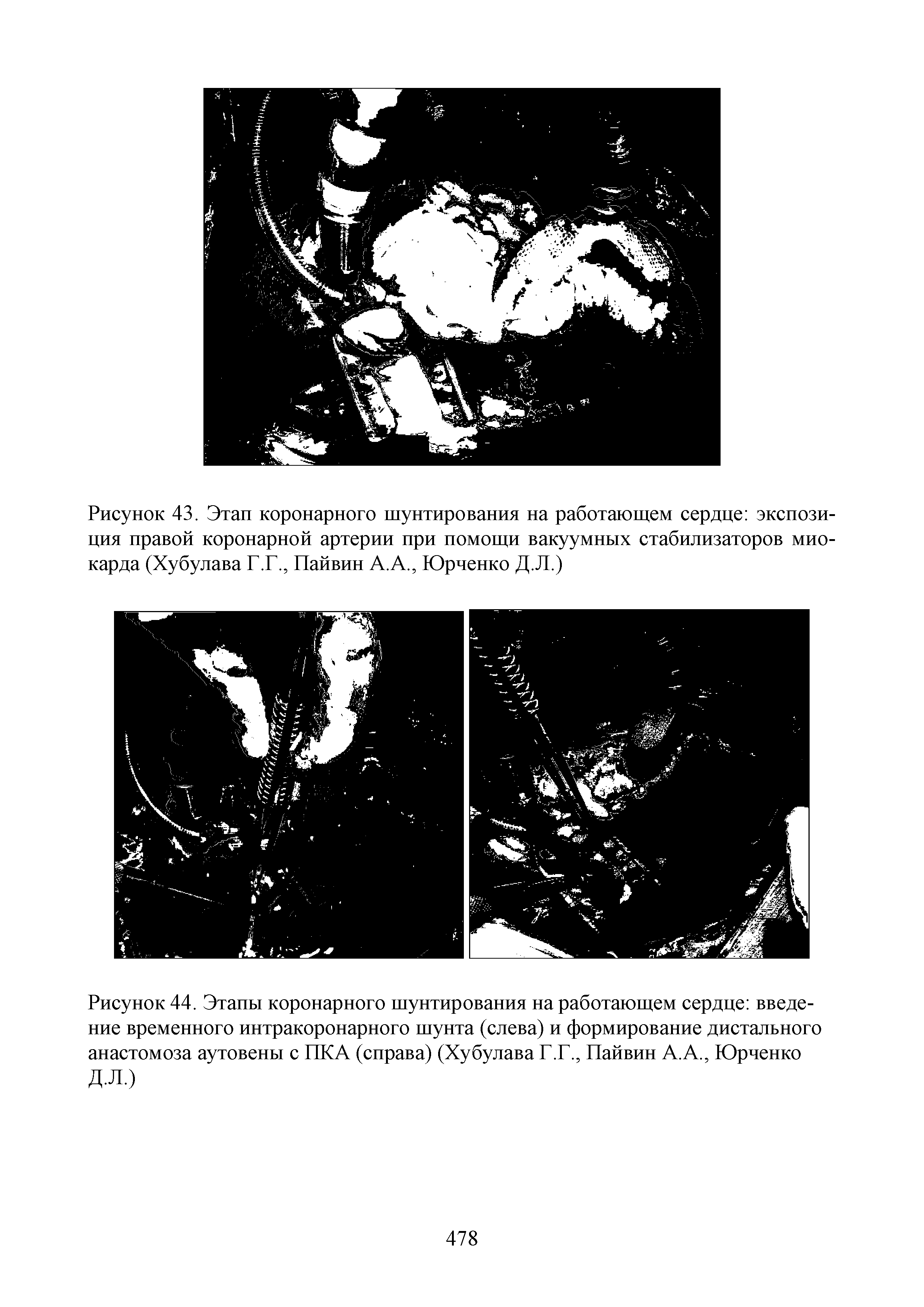 Рисунок 44. Этапы коронарного шунтирования на работающем сердце введение временного интракоронарного шунта (слева) и формирование дистального анастомоза аутовены с ПКА (справа) (Хубулава Г.Г., Пайвин А.А., Юрченко Д.Л.)...