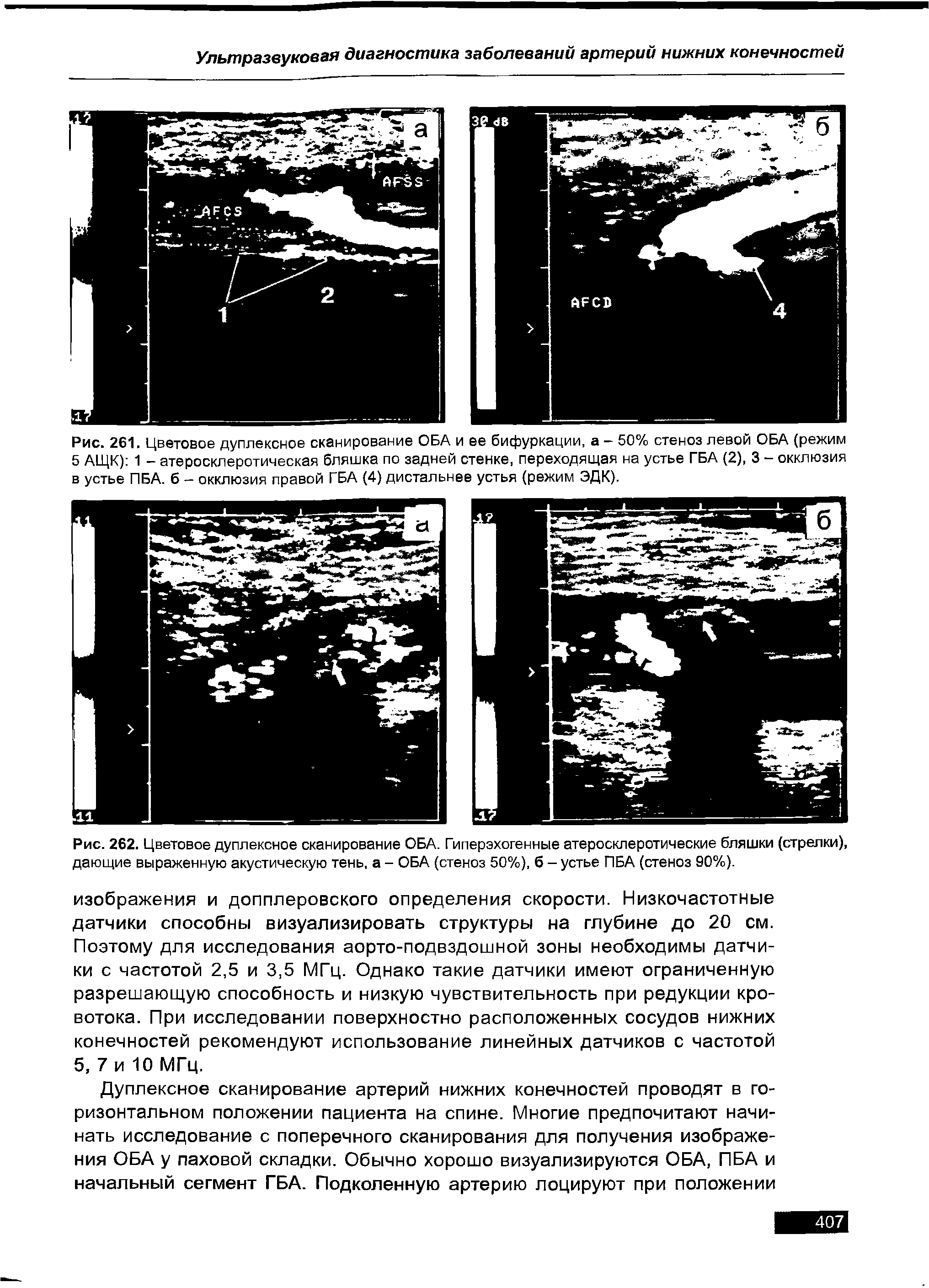 Рис. 261. Цветовое дуплексное сканирование ОБА и ее бифуркации, а - 50% стеноз левой ОБА (режим...