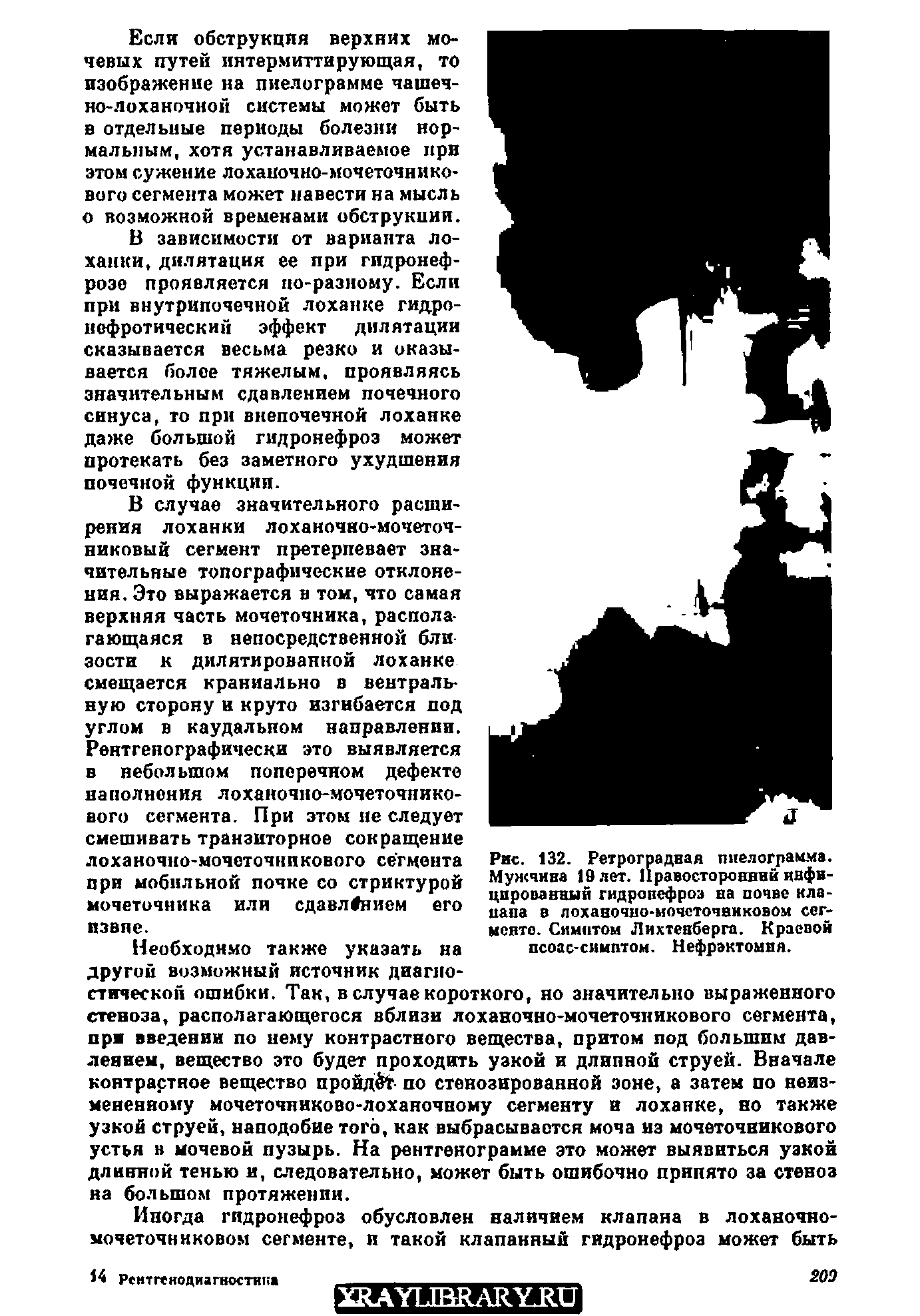 Рис. 132. Ретроградная пиелограмма. Мужчина 19 лет. Правосторонний инфицированный гидропефроэ на почве клацала в лоханочио-мочсточвнковом сегменте. Симптом Лихтенберга. Краевой псоас-симптом. Нефрэктомия.