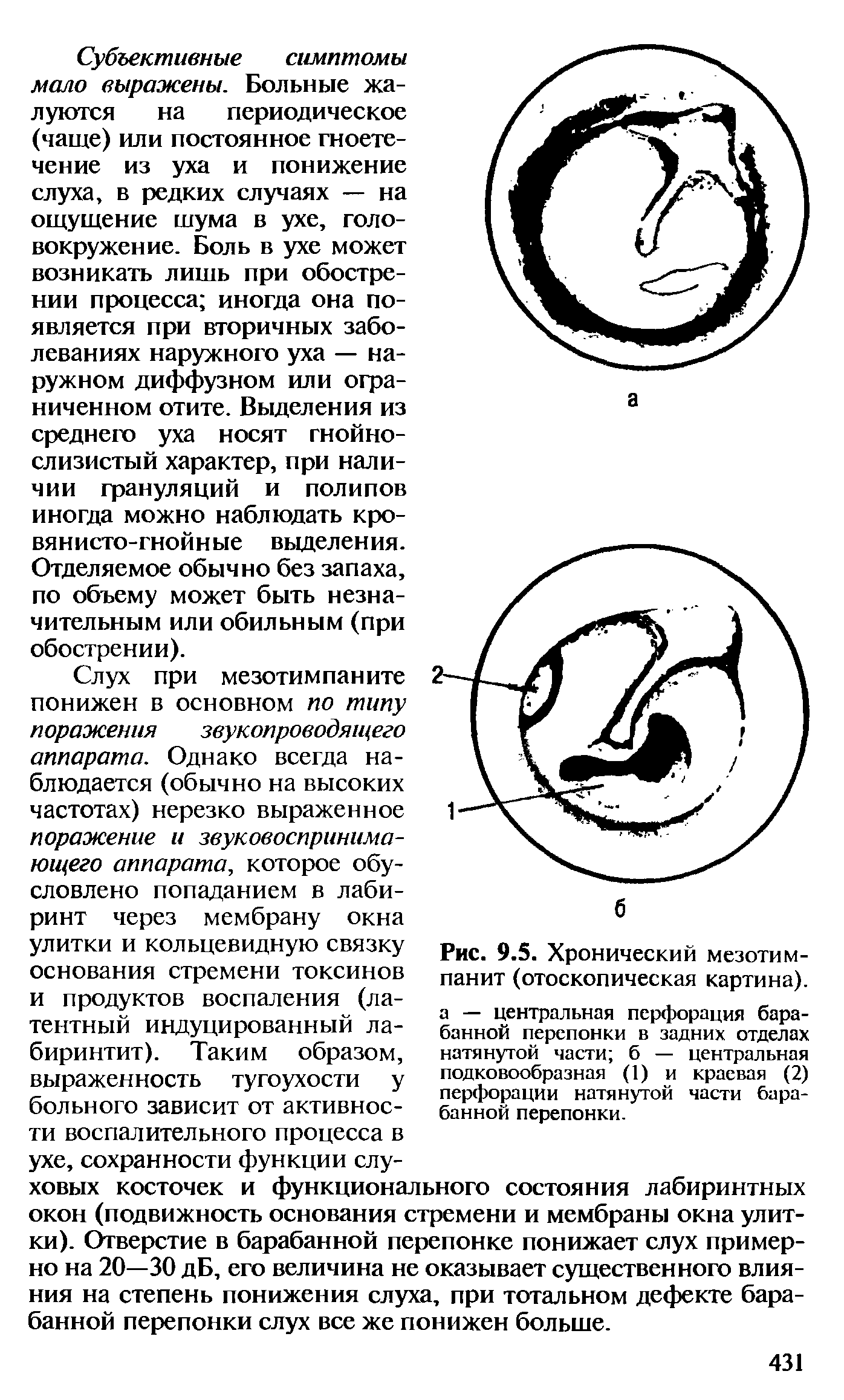 Рис. 9.5. Хронический мезотимпанит (отоскопическая картина), а — центральная перфорация барабанной перепонки в задних отделах натянутой части б — центральная подковообразная (1) и краевая (2) перфорации натянутой части барабанной перепонки.