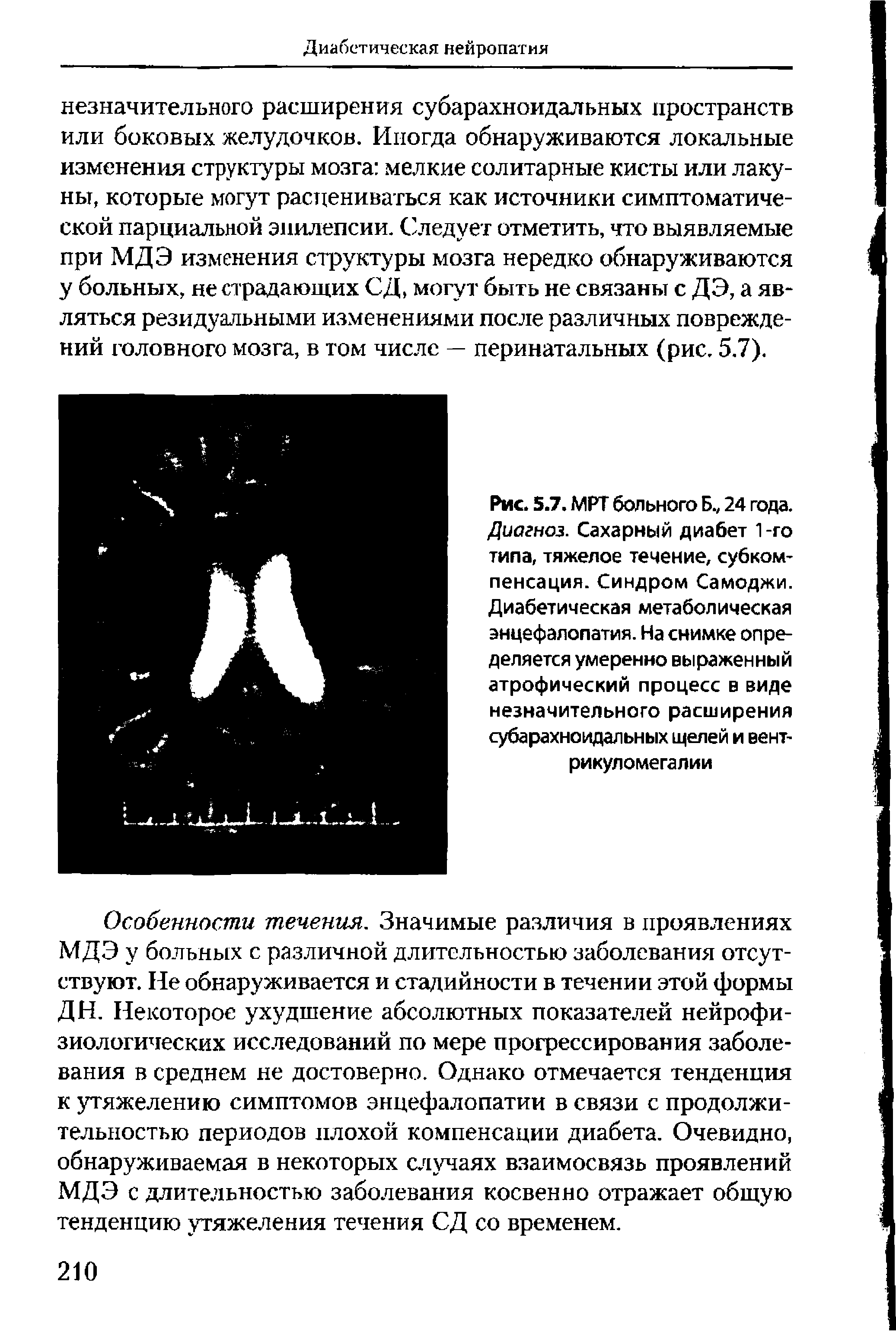 Рис. 5.7. МРТ больного Б., 24 года. Диагноз. Сахарный диабет 1 -го типа, тяжелое течение, субкомпенсация. Синдром Самоджи. Диабетическая метаболическая энцефалопатия. На снимке определяется умеренно выраженный атрофический процесс в виде незначительного расширения субарахноидальных щелей и вент-рикуломегалии...