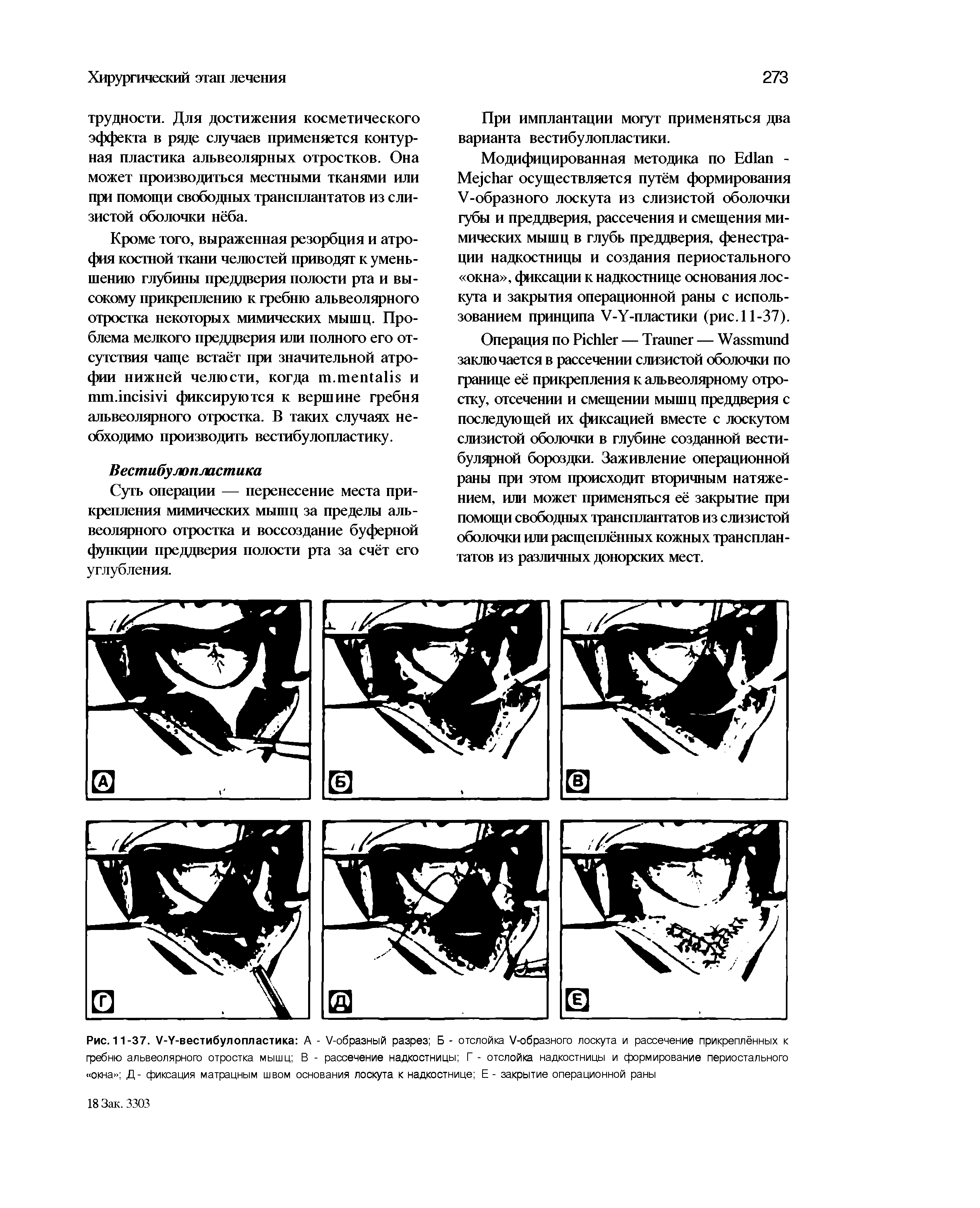 Рис. 11-37. У-У-вестибулопластика А - /-образный разрез Б - отслойка /-образного лоскута и рассечение прикреплённых к гребню альвеолярного отростка мышц В - рассечение надкостницы Г - отслойка надкостницы и формирование периостального окна Д- фиксация матрацным швом основания лоскута к надкостнице Е - закрытие операционной раны...