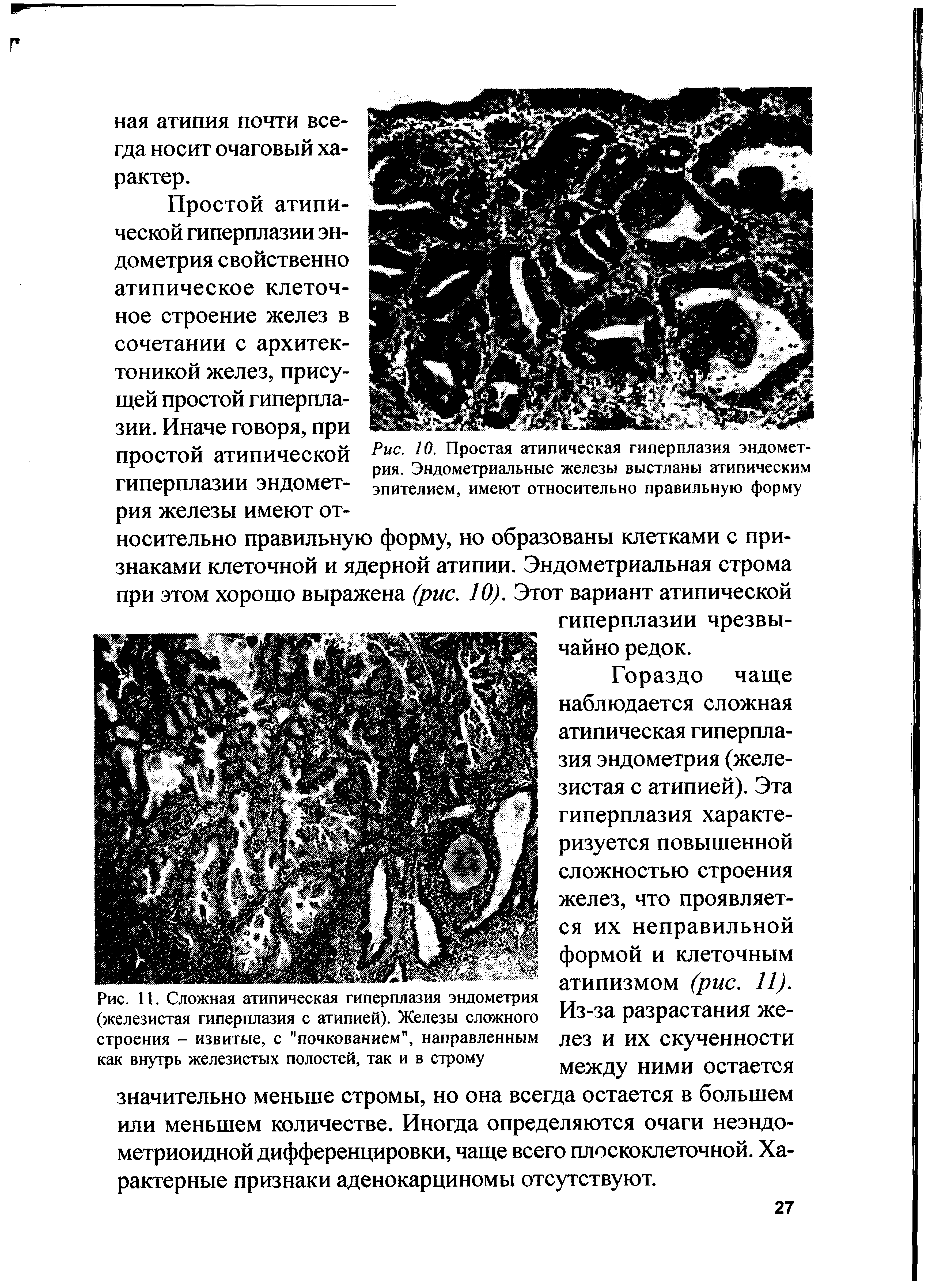 Рис. 11. Сложная атипическая гиперплазия эндометрия (железистая гиперплазия с атипией). Железы сложного строения - извитые, с "почкованием", направленным как внутрь железистых полостей, так и в строму...