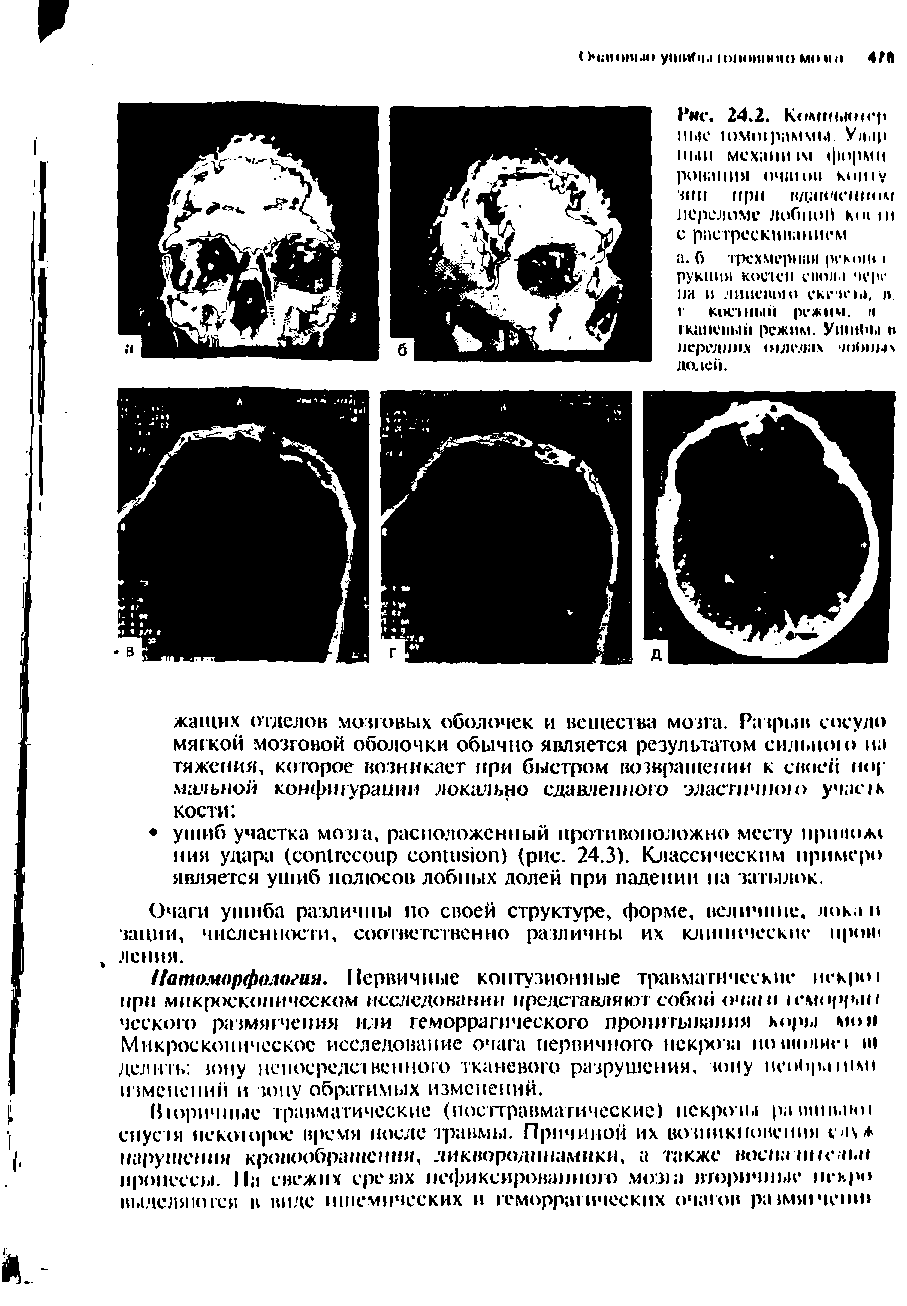 Рис. 24.2. К<>мш.кн< р ные Iомо1 раммы Уи.ч цып мехашим форми рования оч ан кошу тип при H M переломе лобной кш и с растрескиванием а. б трехмерная рекой рукиия костей енола чере на и липешио СКГИ-Ы. и. г Кост . режим, и тканевый режим, . н передних шлелах > >< >. долей.