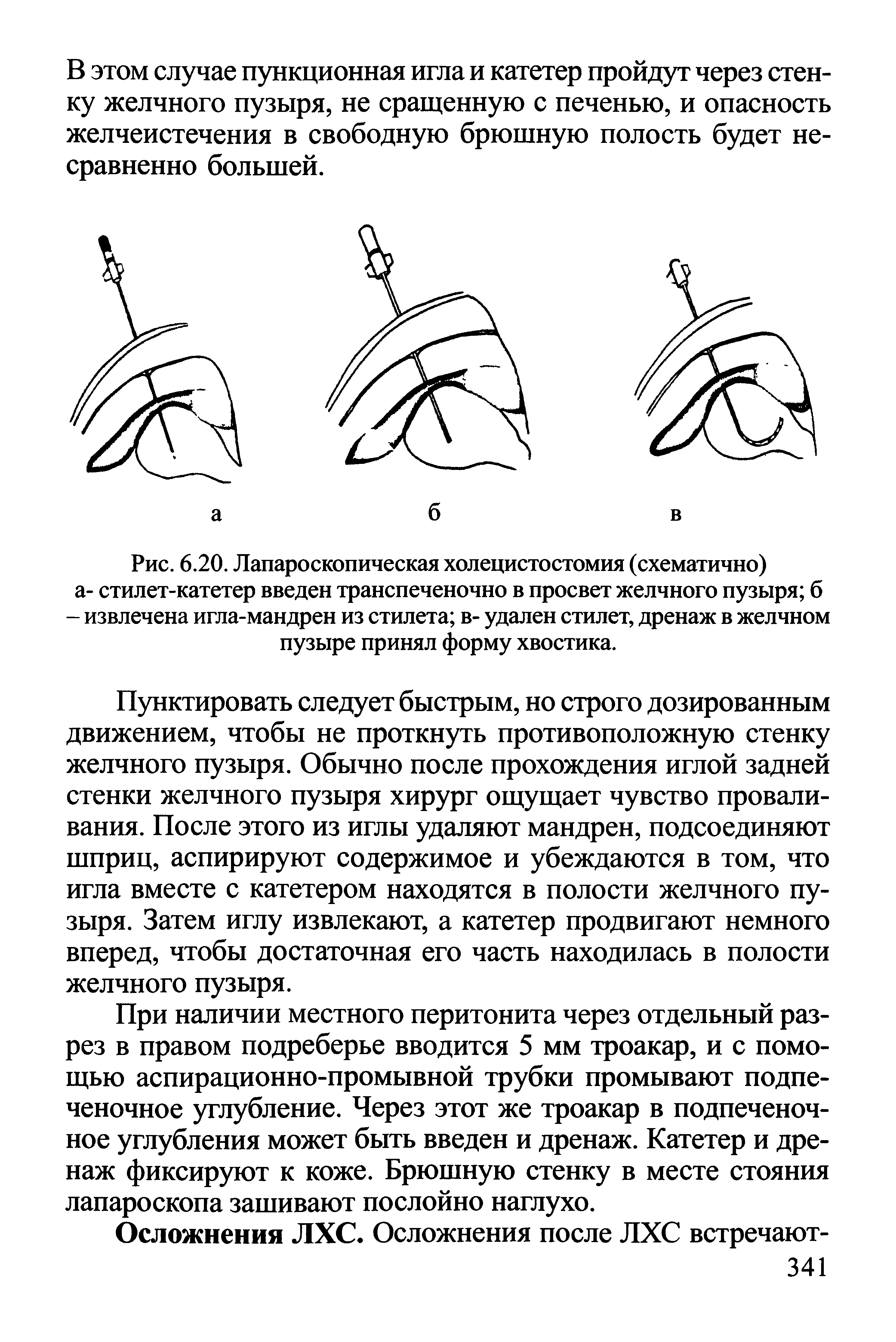 Рис. 6.20. Лапароскопическая холецистостомия (схематично) а- стилет-катетер введен транспеченочно в просвет желчного пузыря б - извлечена игла-мандрен из стилета в- удален стилет, дренаж в желчном пузыре принял форму хвостика.