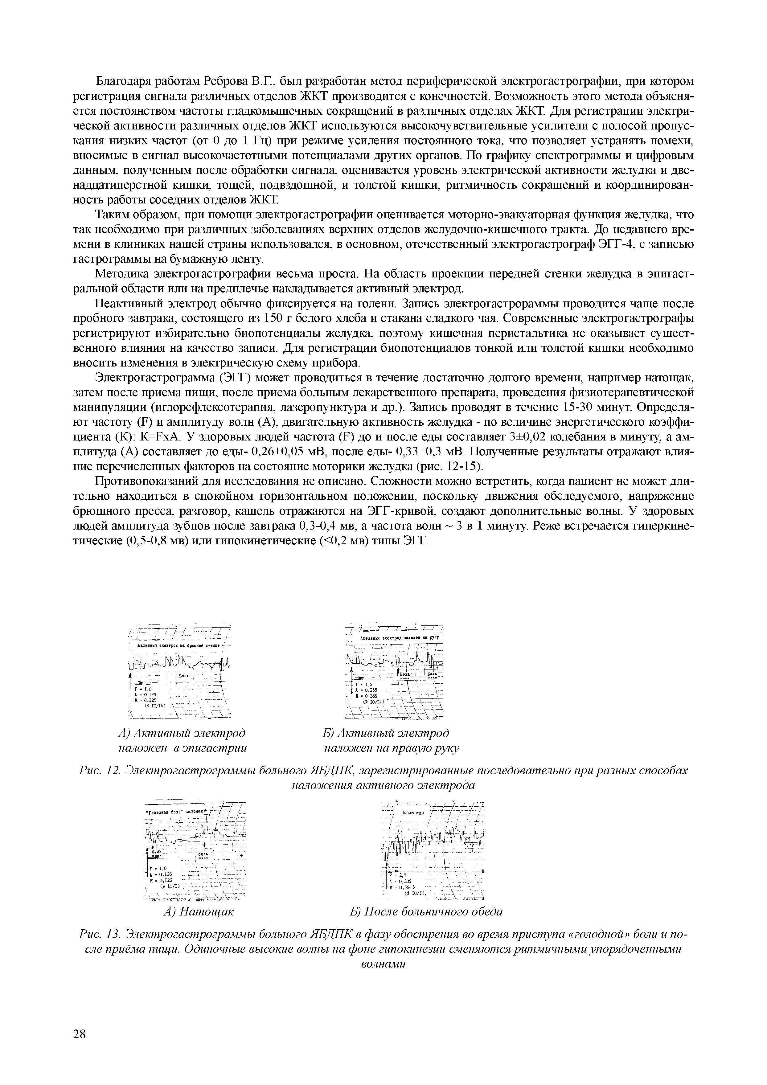 Рис. 13. Электрогастрограммы больного ЯБДПК в фазу обострения во время приступа голодной боли и после приёма пищи. Одиночные высокие волны на фоне гипокинезии сменяются ритмичными упорядоченными волнами...