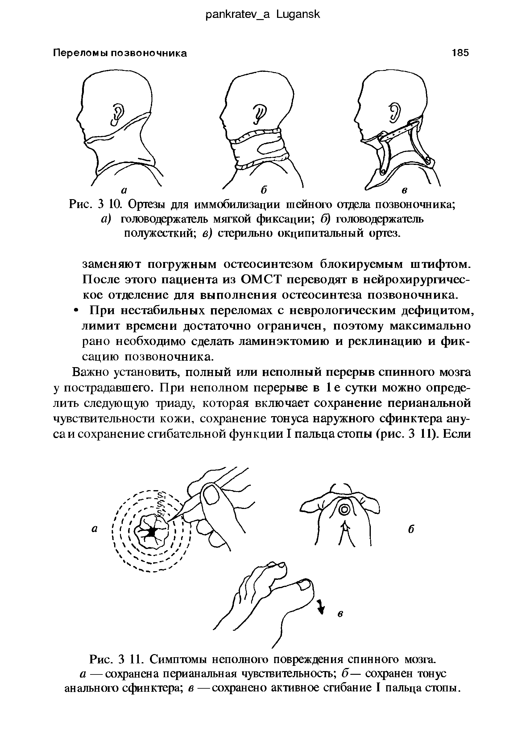 Рис. 3 11. Симптомы неполного повреждения спинного мозга. а —сохранена перианальная чувствительность б— сохранен тонус анального сфинктера в —сохранено активное сгибание I пальца стопы.