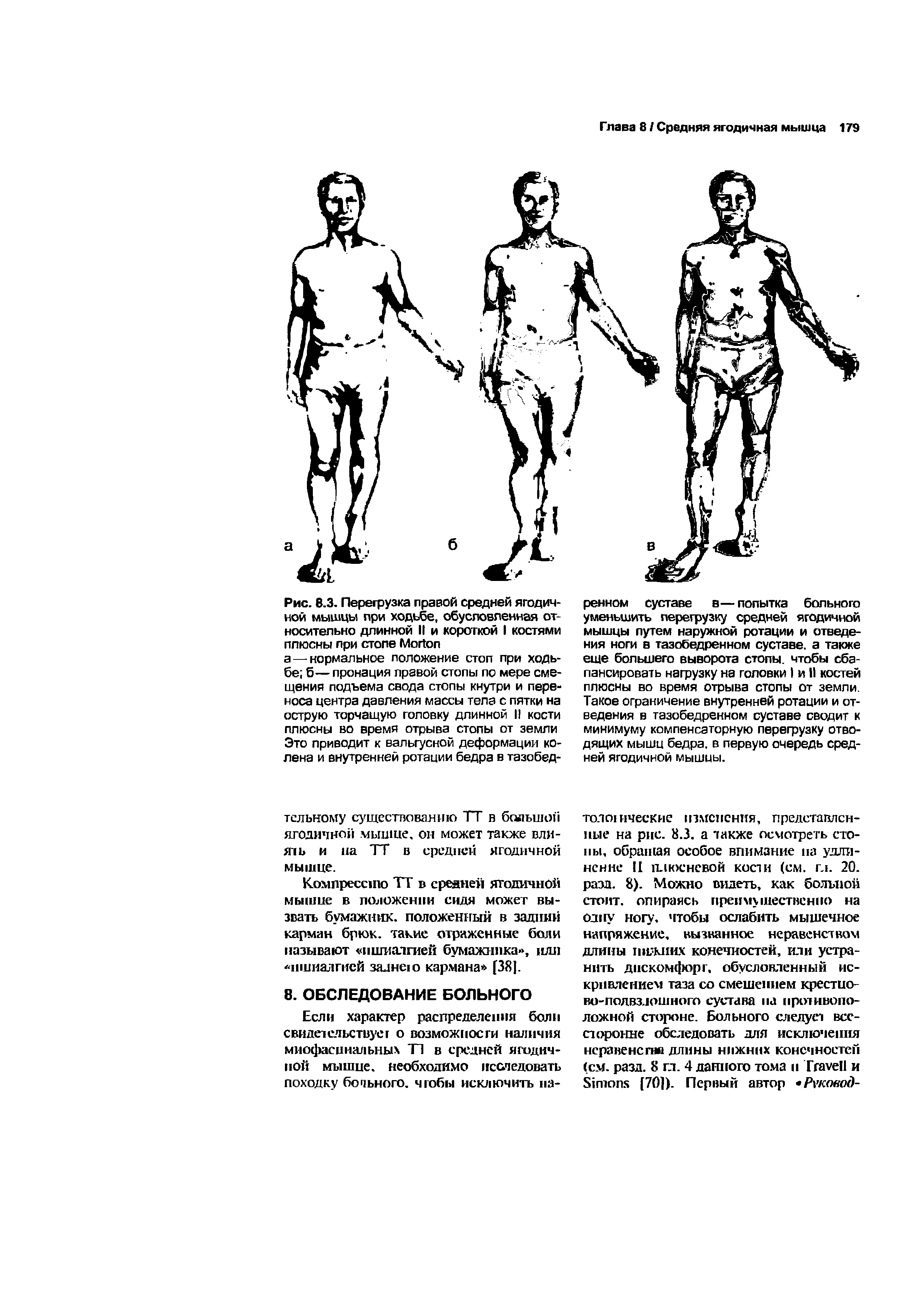 Рис. 8.3. Перегрузка правой средней ягодичной мышцы при ходьбе, обусловленная относительно длинной II и короткой I костями плюсны при стопе M ...