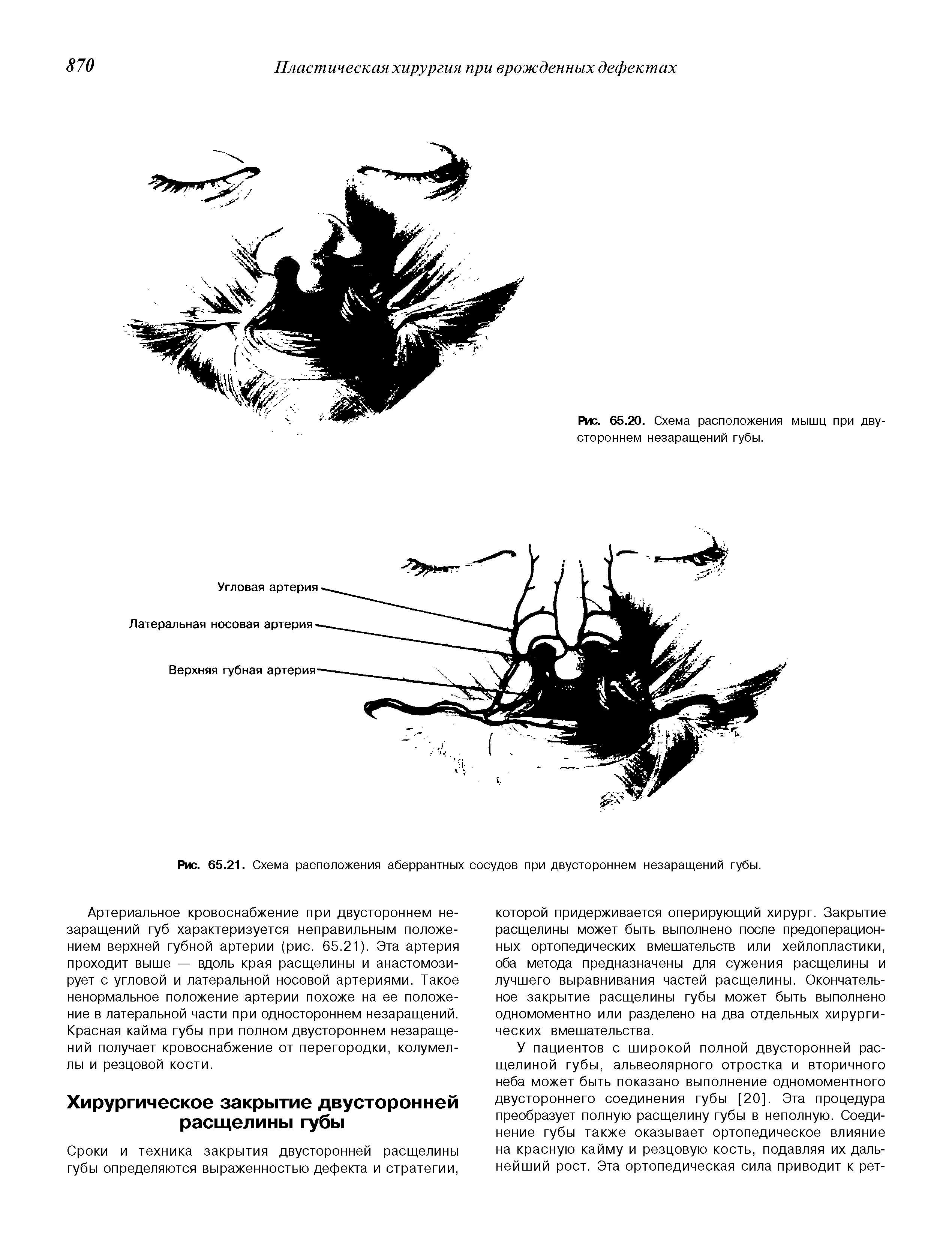 Рис. 65.21. Схема расположения аберрантных сосудов при двустороннем незаращений губы.