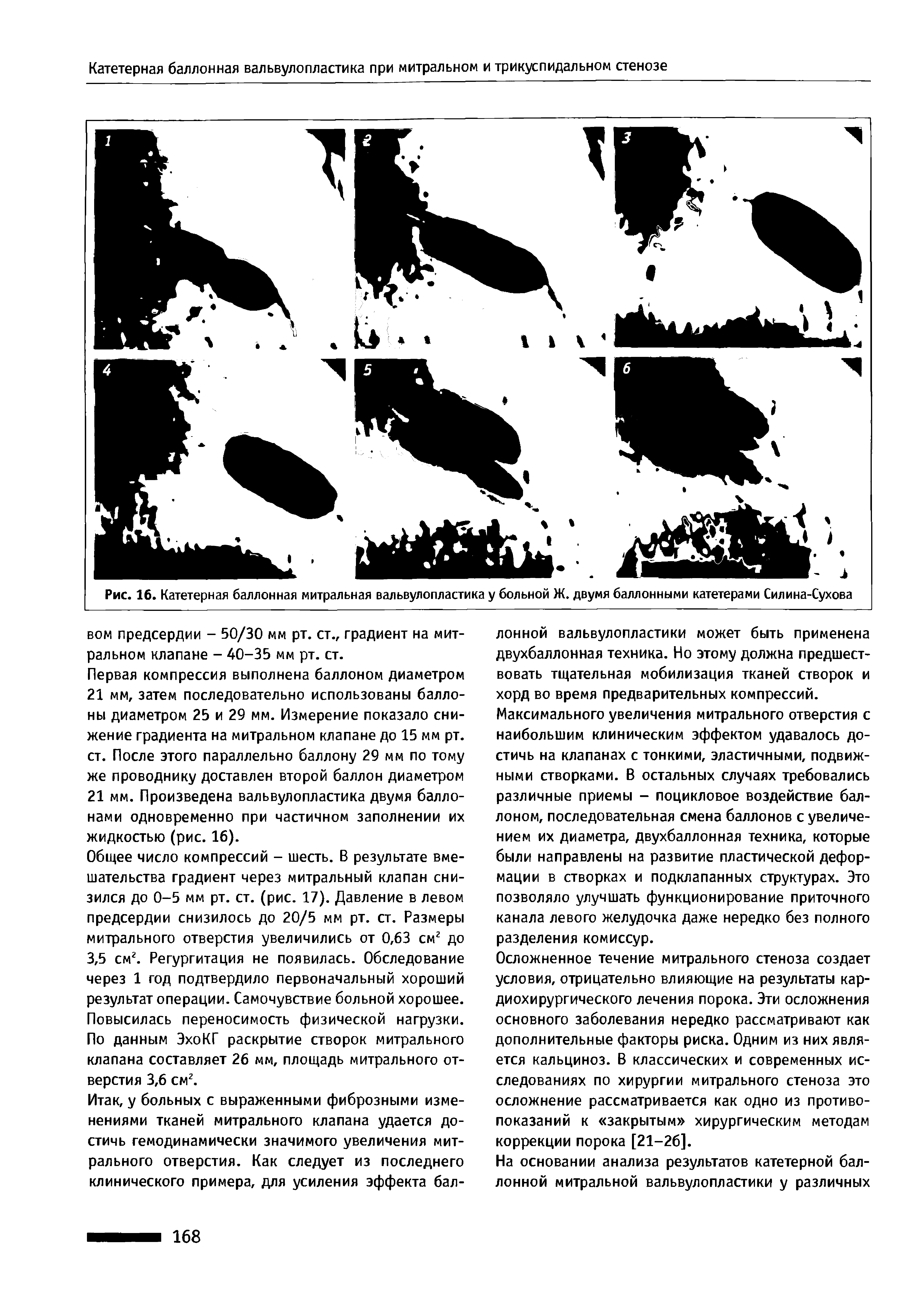 Рис. 16. Катетерная баллонная митральная вальвулопластика у больной Ж. двумя баллонными катетерами Силина-Сухова...