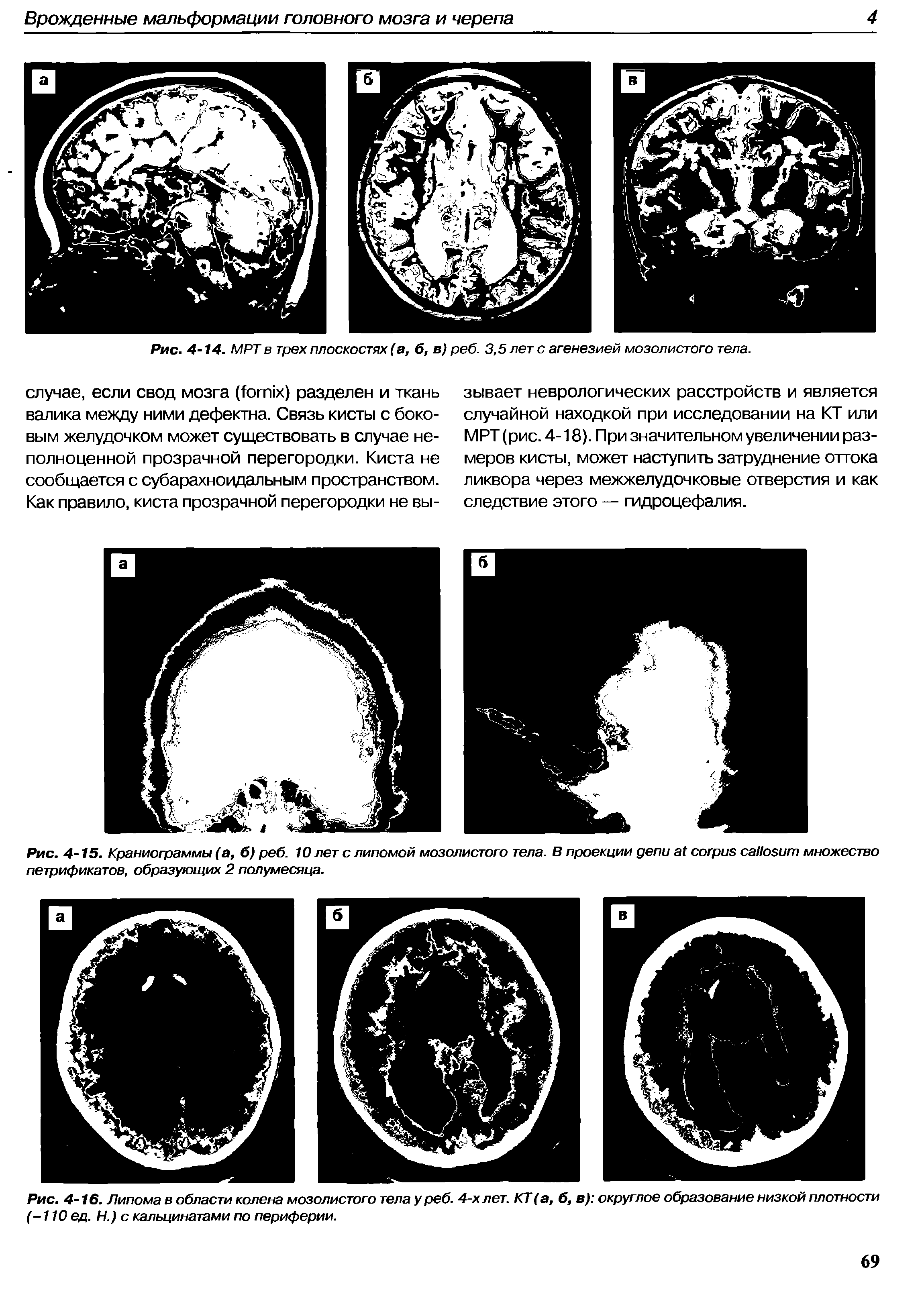 Рис. 4-16. Липома в области колена мозолистого тела у реб. 4-х лет. КТ (а, б, в) округлое образование низкой плотности (-110 ед. Н.) с кальцинатами по периферии.