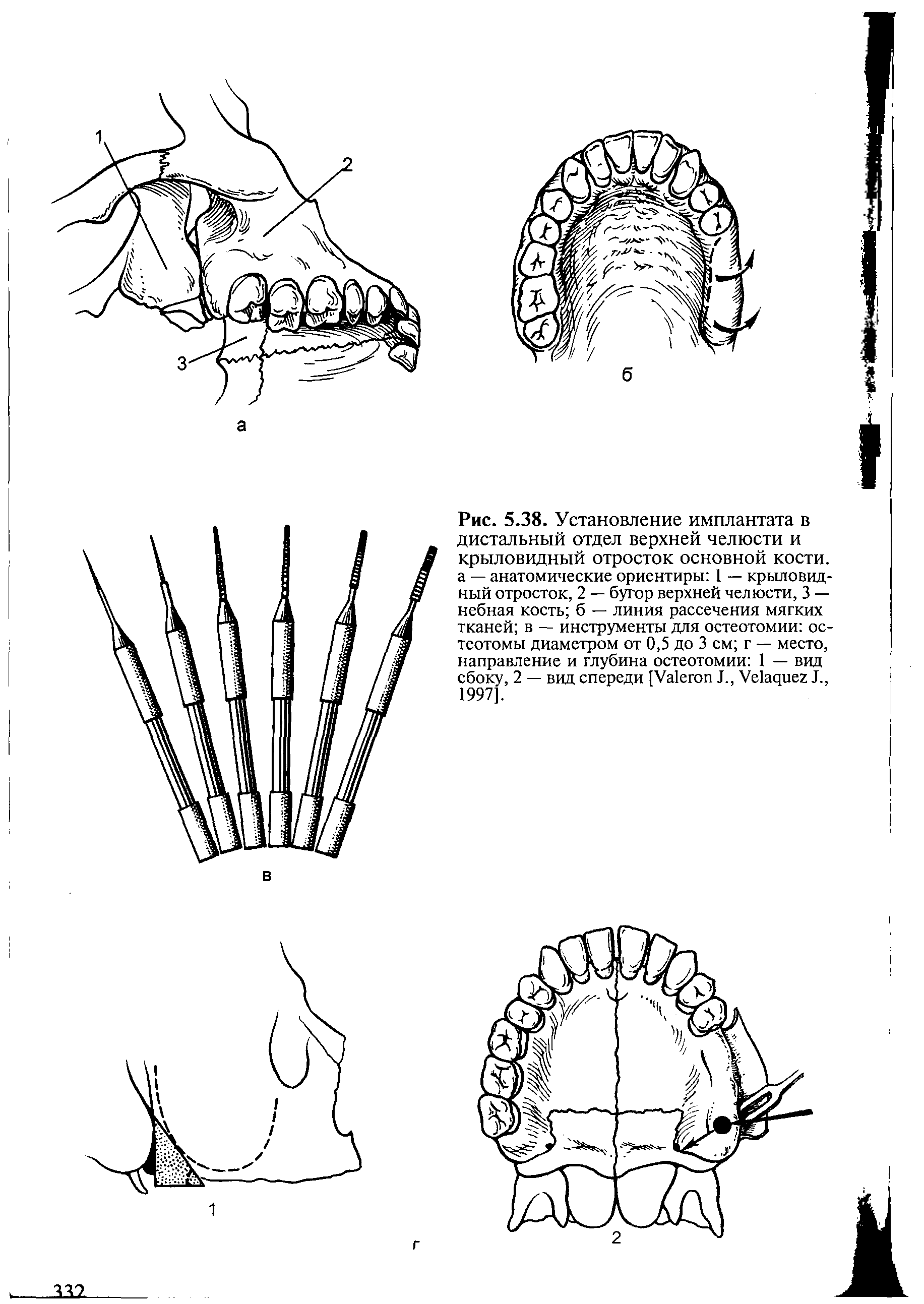 Рис. 5.38. Установление имплантата в дистальный отдел верхней челюсти и крыловидный отросток основной кости, а — анатомические ориентиры 1 — крыловидный отросток, 2 — бугор верхней челюсти, 3 — небная кость б — линия рассечения мягких тканей в — инструменты для остеотомии ос-теотомы диаметром от 0,5 до 3 см г — место, направление и глубина остеотомии 1 — вид сбоку, 2 — вид спереди [Уа1егоп I., Уе1ачиег 1., 1997].