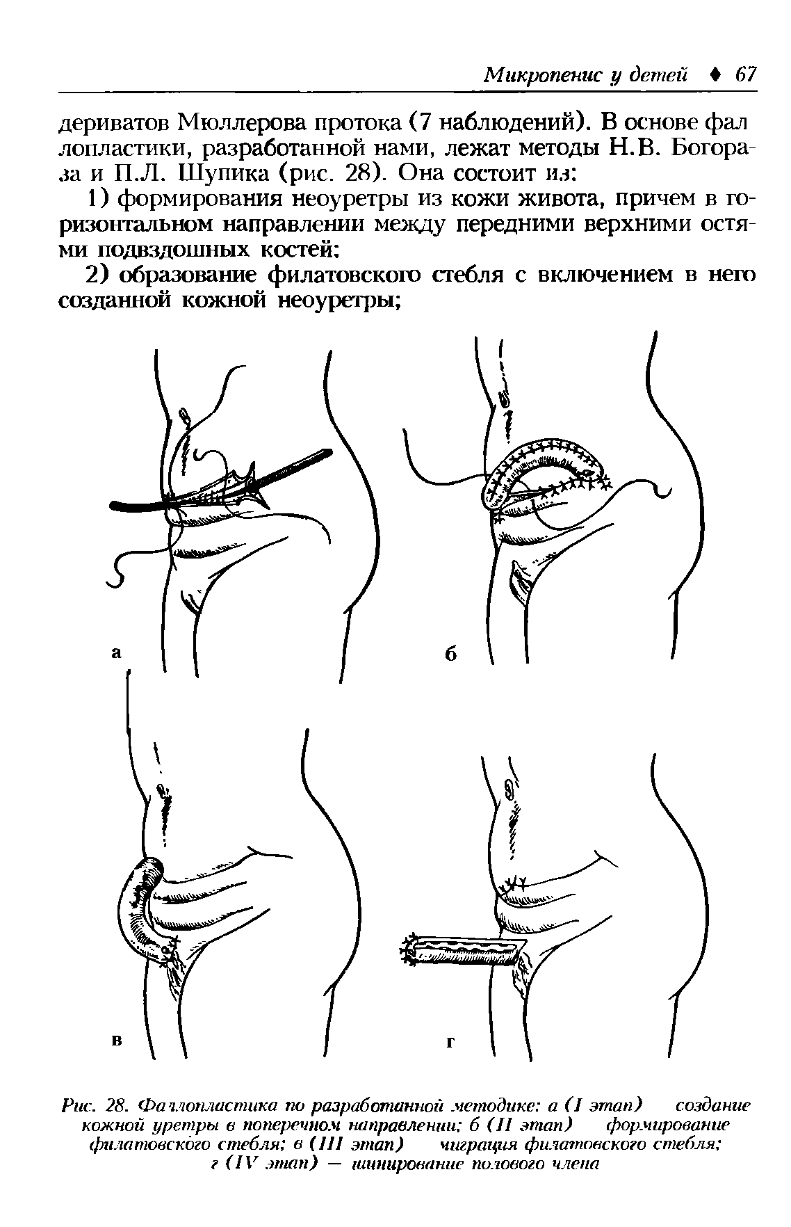 Рис. 28. Фачлопластика по разработанной методике а (I этап) создание кожной уретры в поперечном направлении б (И этап) формирование филатовского стебля в (111 этап) чиграция филатовского стебля г (IV этап) — шинирование полового члена...