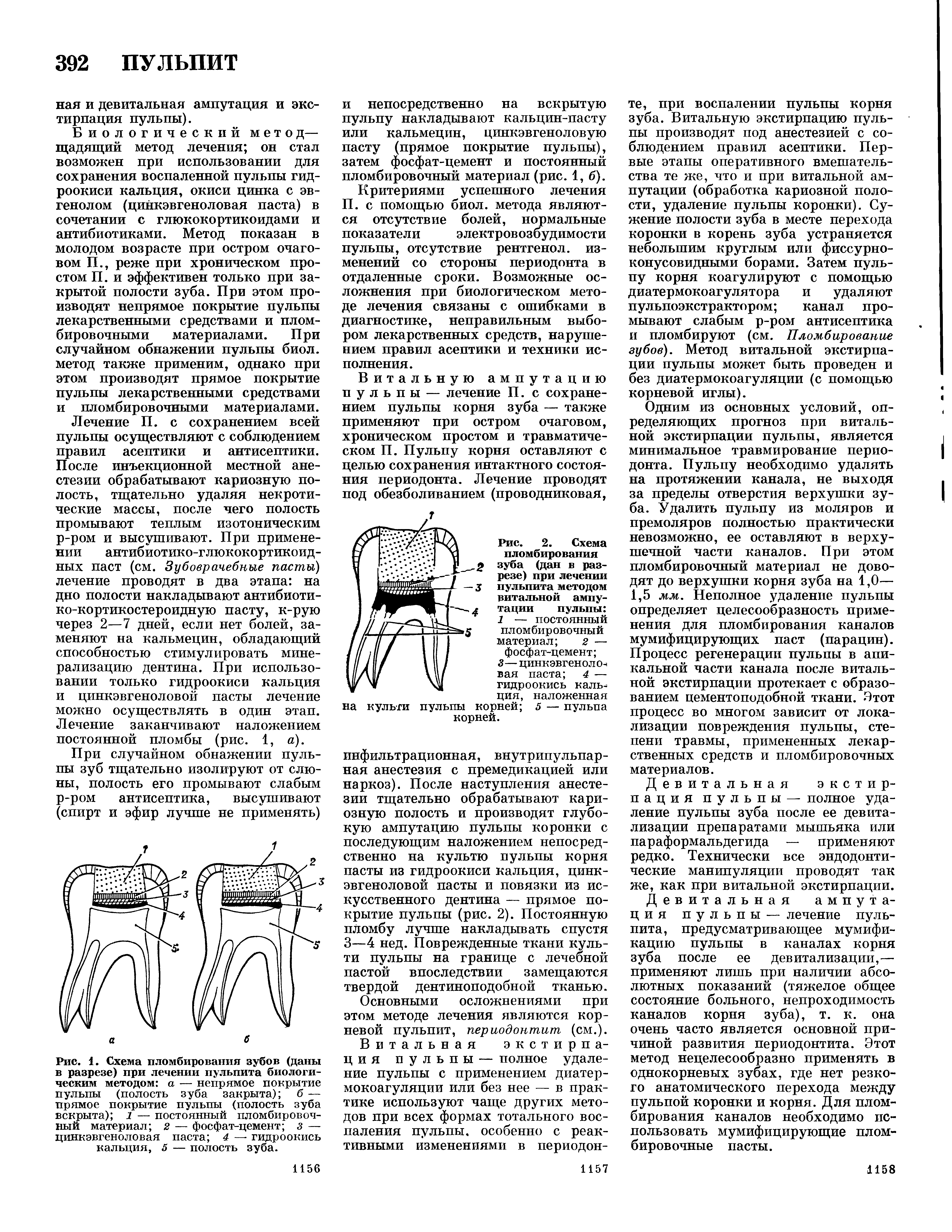 Рис. 1. Схема пломбирования зубов (даны в разрезе) при лечении пульпита биологическим методом а — непрямое покрытие пульпы (полость зуба закрыта) б — прямое покрытие пульпы (полость зуба вскрыта) 1 — постоянный пломбировочный материал 2 — фосфат-цемент з — цинкэвгеноловая паста 4 — гидроокись кальция, 5 — полость зуба.