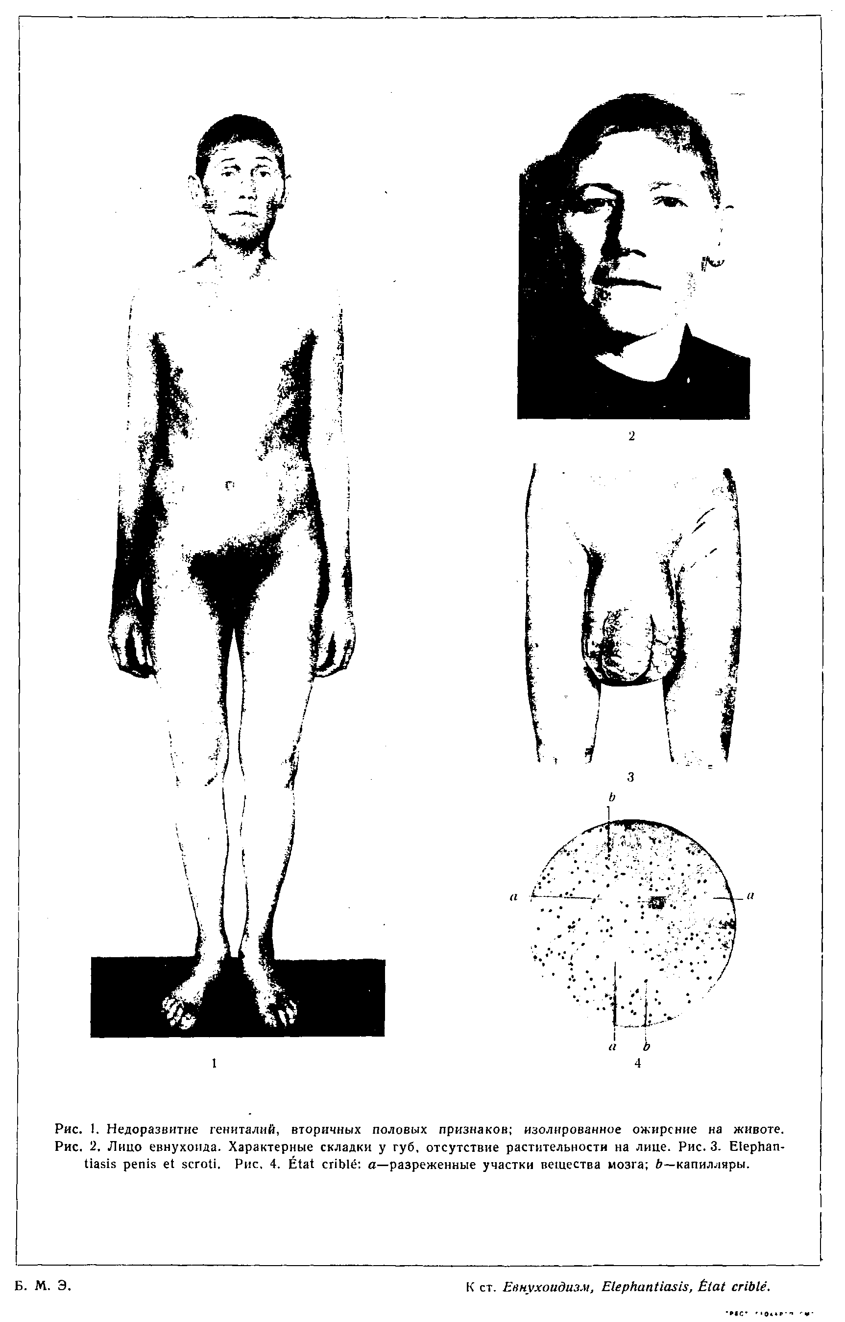 Рис. 2. Лицо евнухоида. Характерные складки у губ, отсутствие растительности на лице. Рис. 3. E . Рис. 4. —разреженные участки вещества мозга —капилляры.
