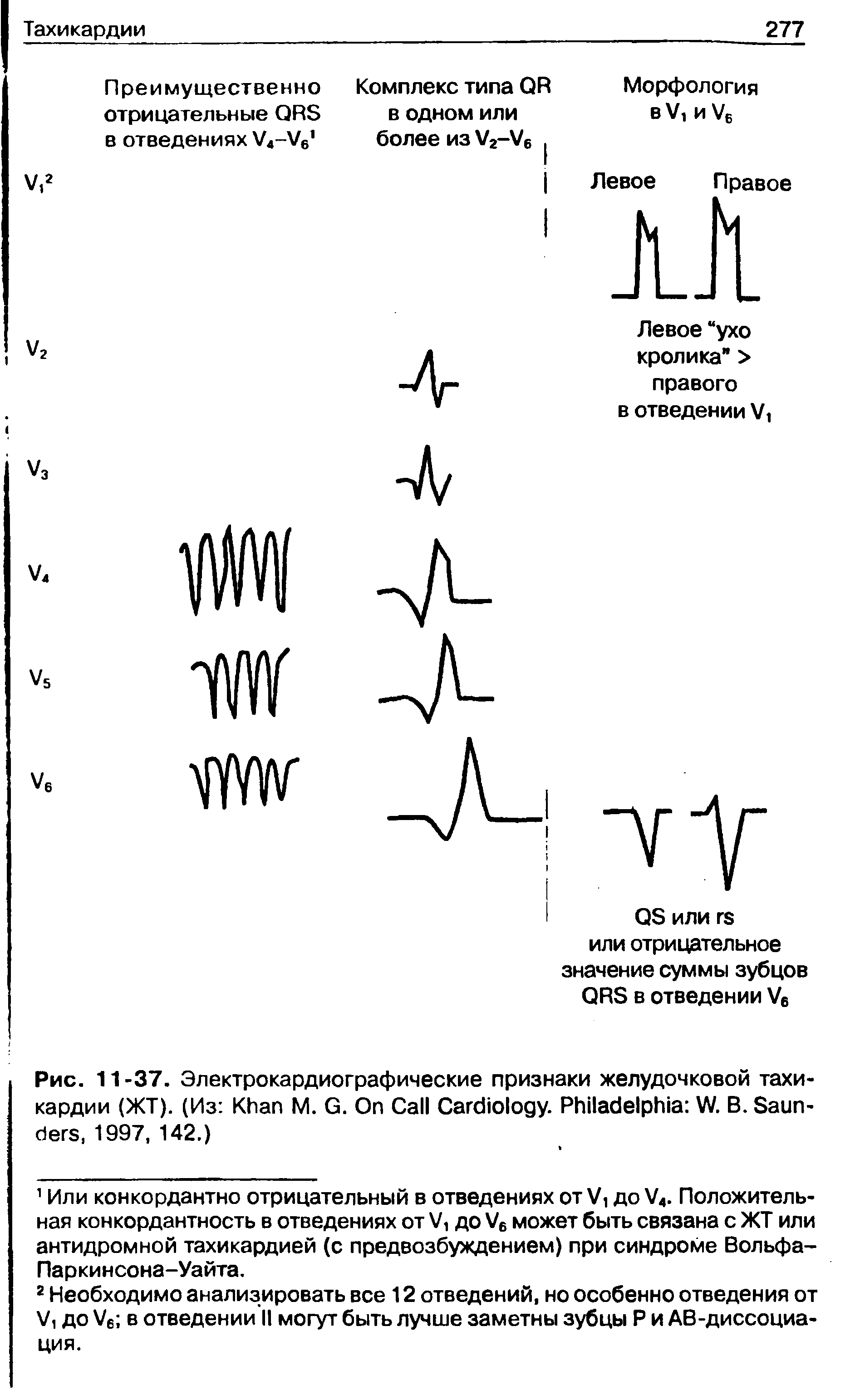 Рис. 11 -37. Электрокардиографические признаки желудочковой тахикардии (ЖТ). (Из K М. G. O C C . P W. В. S , 1997, 142.)...