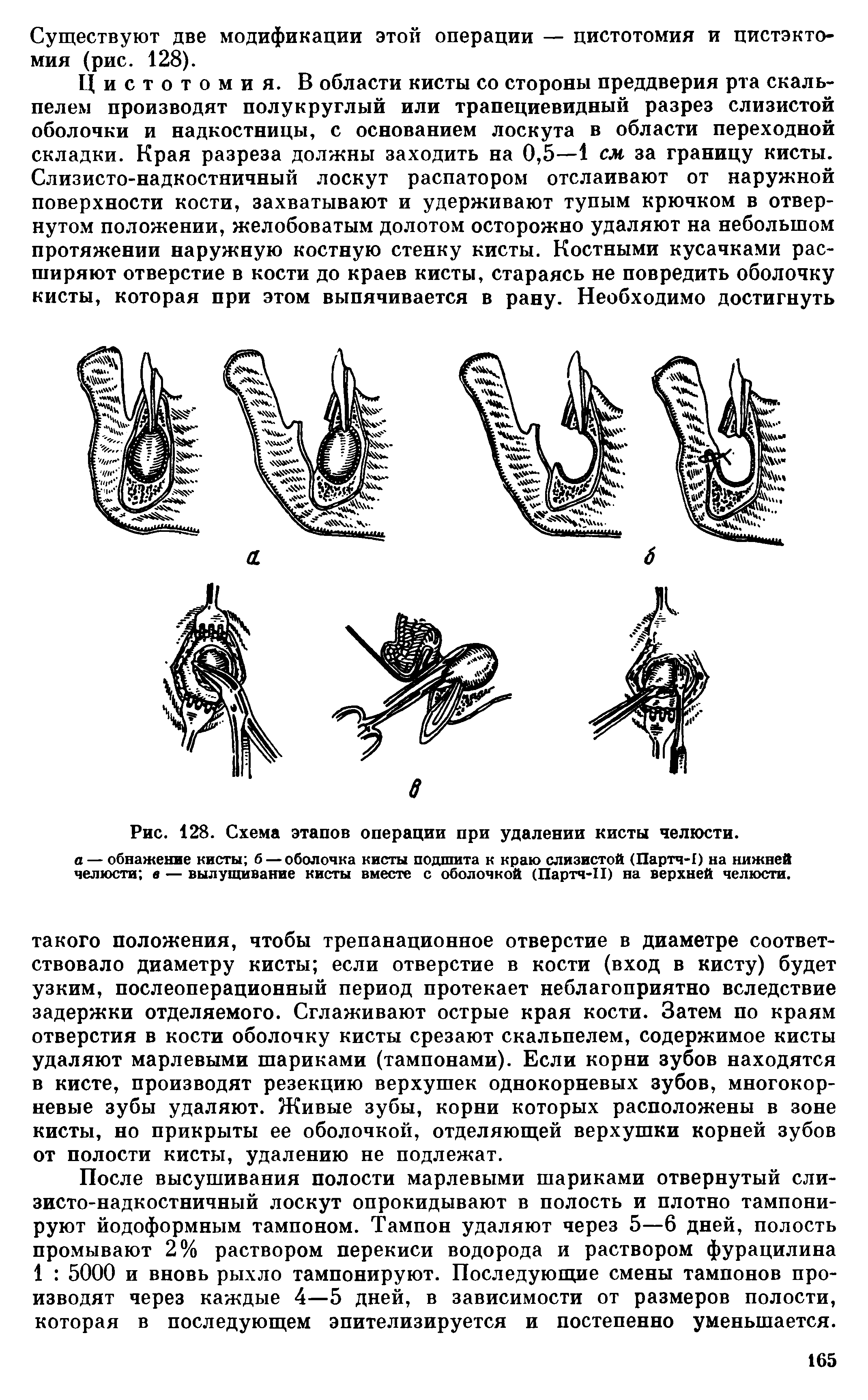 Рис. 128. Схема этапов операции при удалении кисты челюсти.