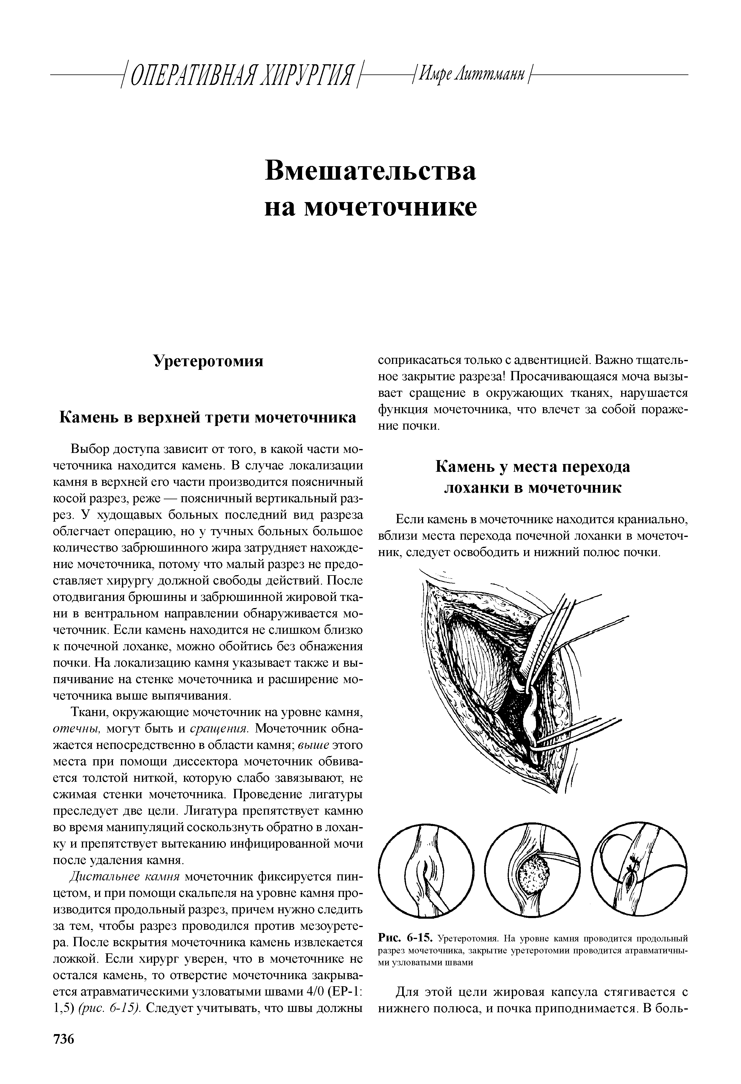 Рис. 6-15. Уретеротомия. На уровне камня проводится продольный разрез мочеточника, закрытие уретеротомии проводится атравматичными узловатыми швами...