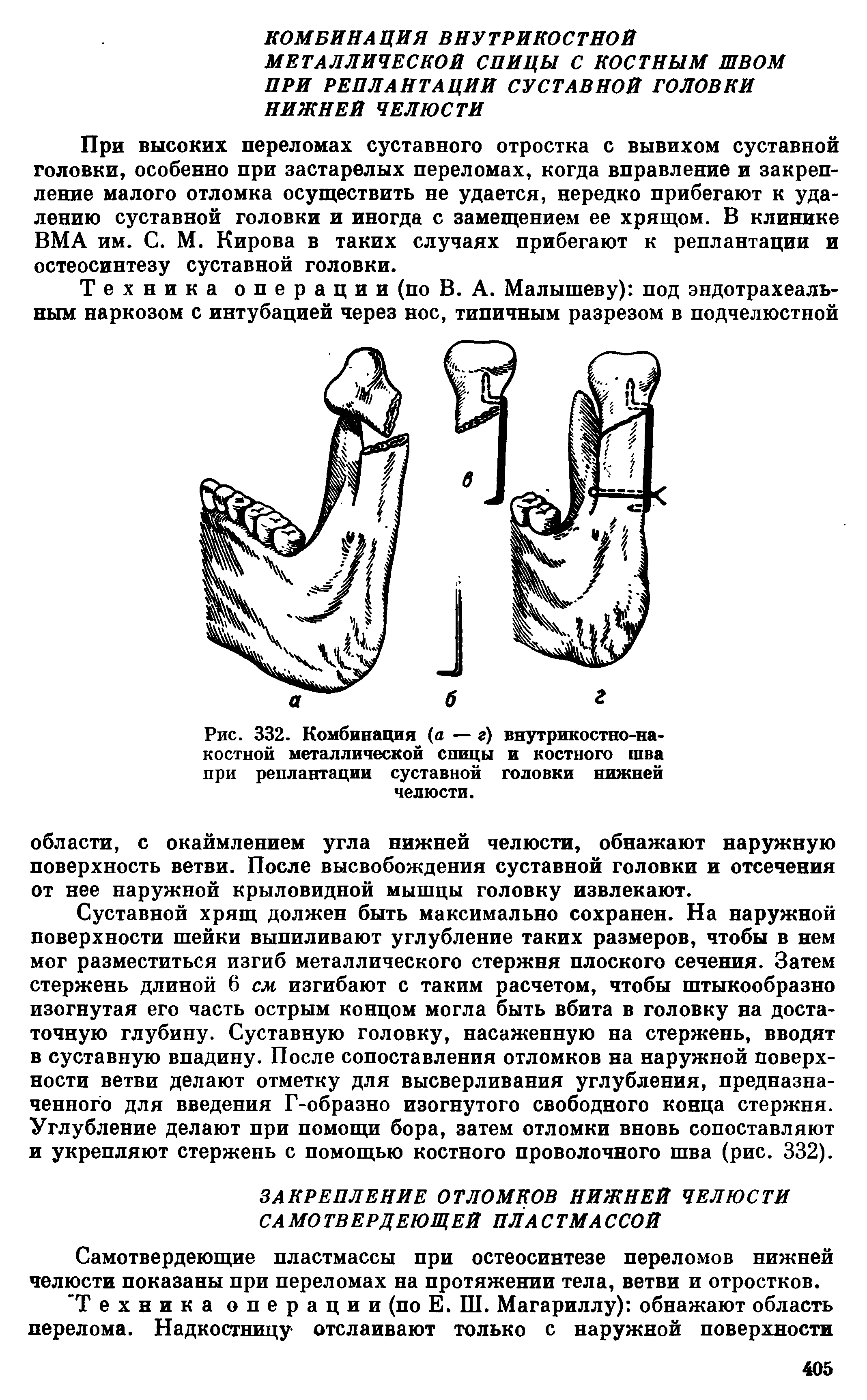 Рис. 332. Комбинация (а — г) внутрикостно-накостной металлической спицы и костного шва при реплантации суставной головки нижней челюсти.