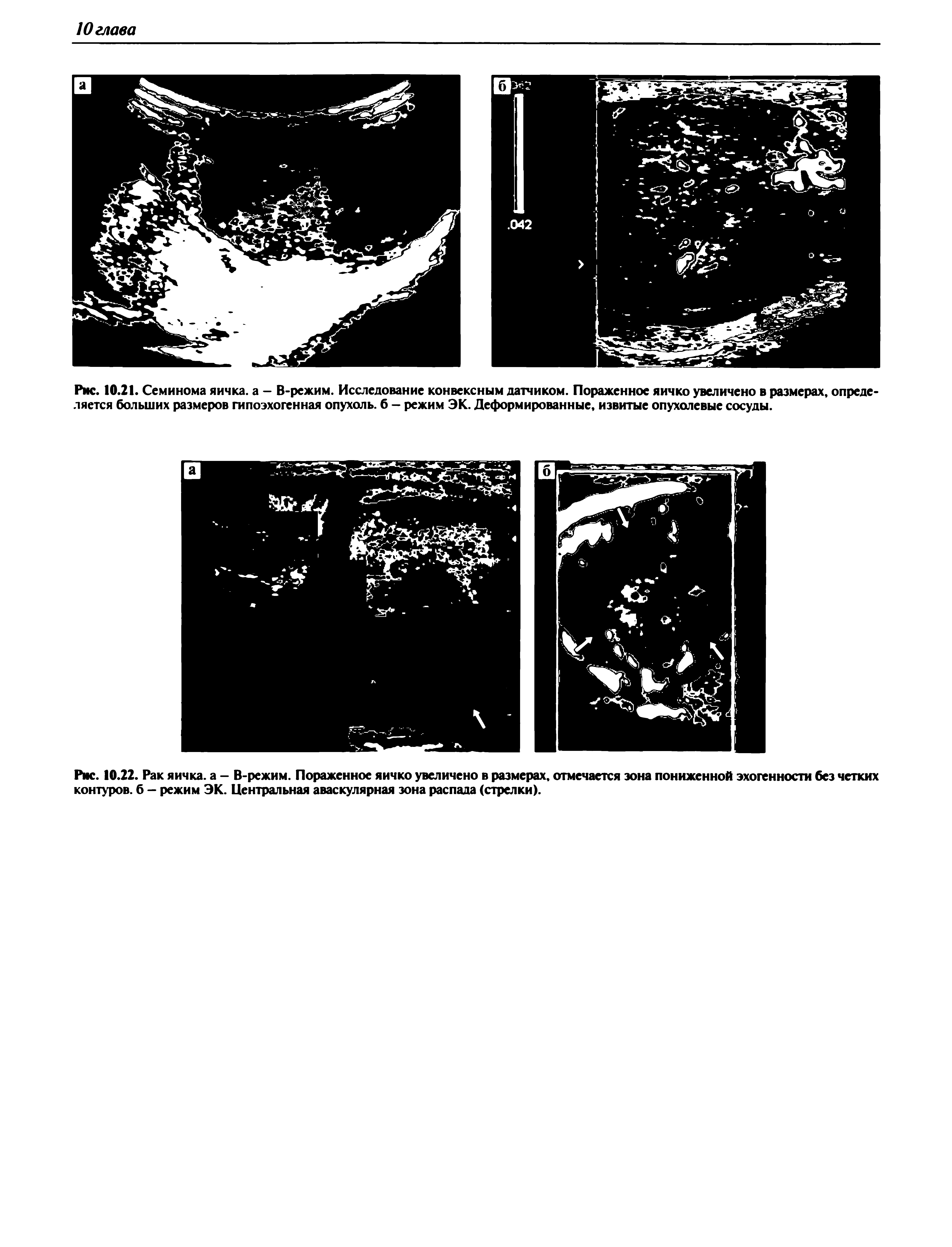 Рис. 10.22. Рак яичка, а - В-режим. Пораженное яичко увеличено в размерах, отмечается зона пониженной эхогенности без четких контуров, б - режим ЭК. Центральная аваскулярная зона распада (стрелки).
