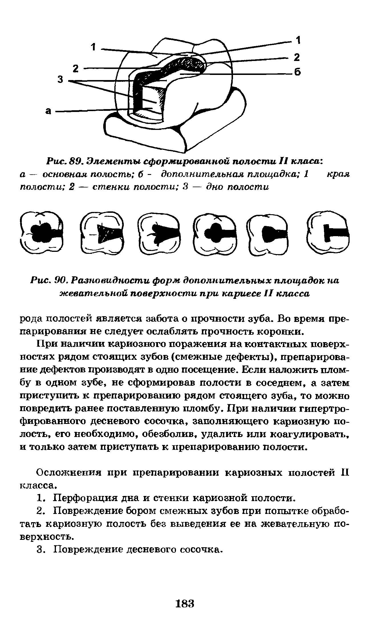 Рис. 90. Разновидности форм дополнительных площадок на жевательной поверхности при кариесе II класса...