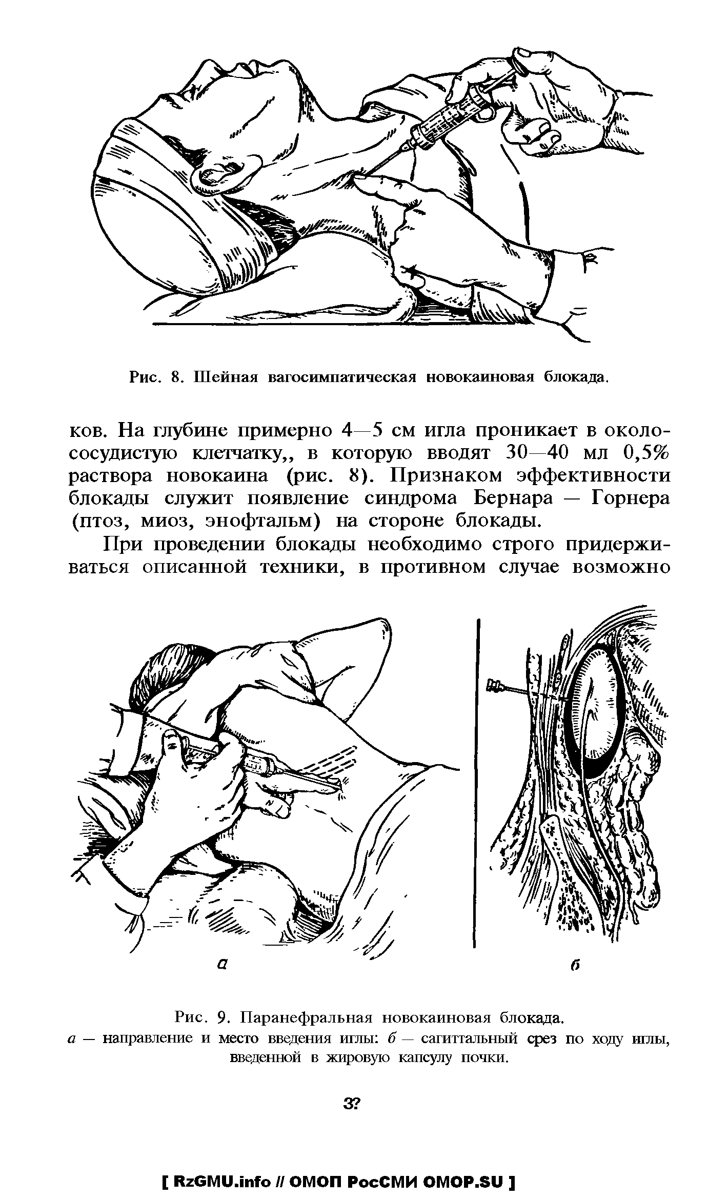 Рис. 9. Паранефральная новокаиновая блокада. а — направление и место введения иглы б — сагиттальный срез по ходу иглы, введенной в жировую капсулу почки.