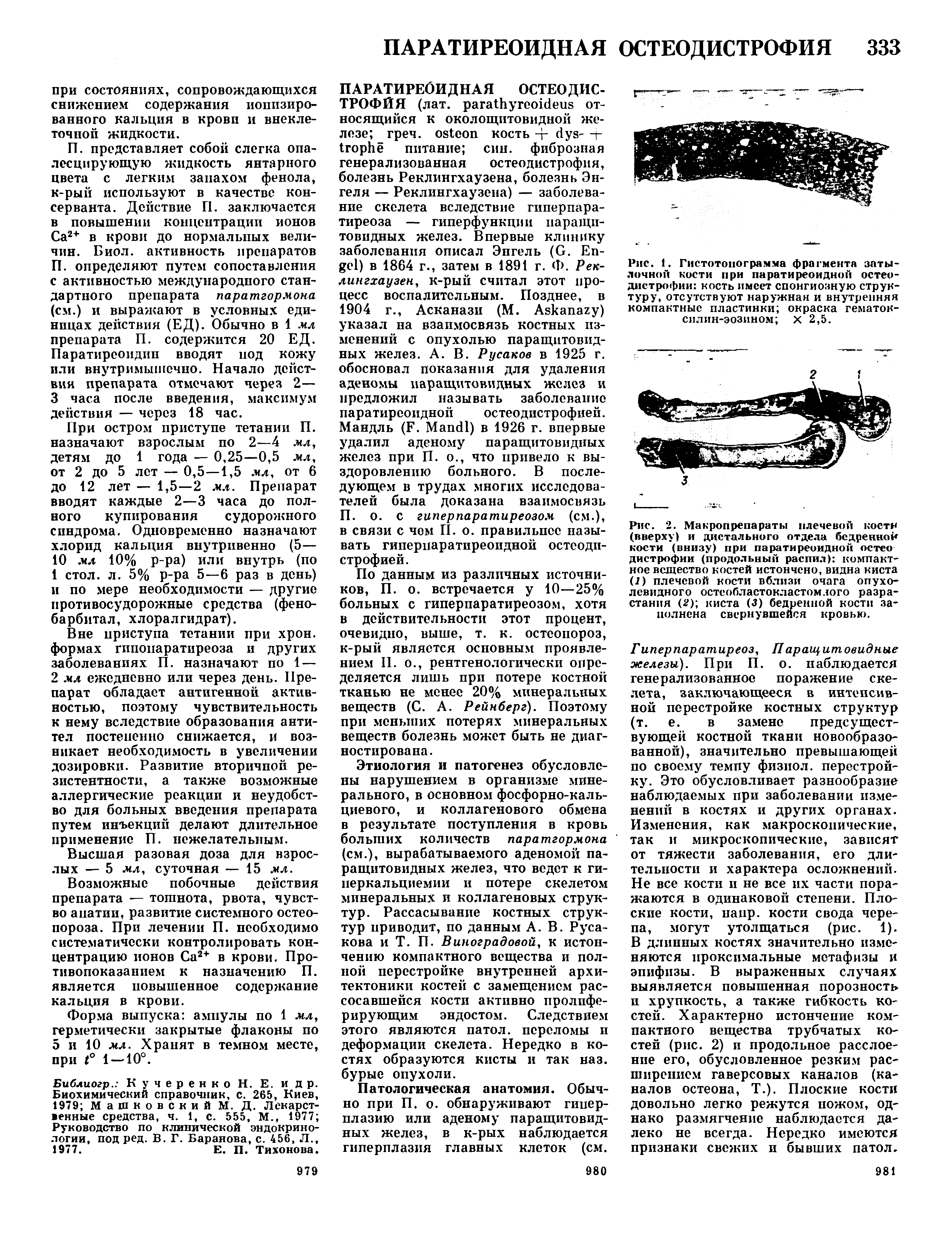 Рис. 2. Макропрепараты плечевой костя (вверху) и дистального отдела бедренной кости (внизу) при паратиреоидной остео дистрофии (продольный распил) компактное вещество костей истончено, видна киста (7) плечевой кости вблизи очага опухолевидного остеобластокластомлого разрастания (2) киста (3) бедренной кости заполнена свернувшейся кровью.