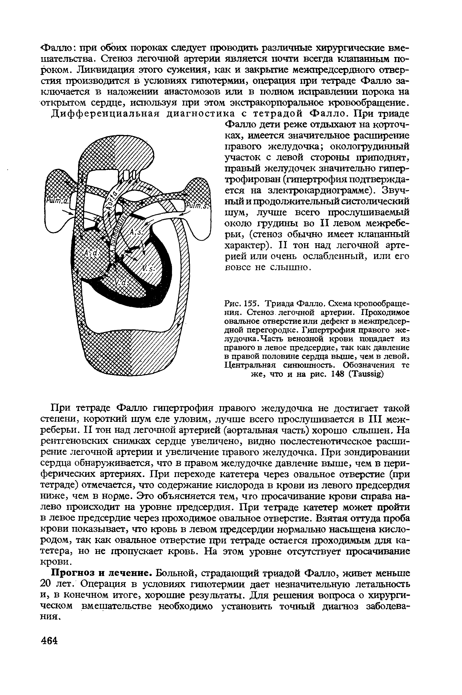 Рис. 155. Триада Фалло. Схема кровообращения. Стеноз легочной артерии. Проходимое овальное отверстие или дефект в межпредсердной перегородке. Гипертрофия правого желудочка. Часть венозной крови попадает из правого в левое предсердие, так как давление в правой половине сердца вьцпе, чем в левой. Центральная синюшность. Обозначения те же, что и на рис. 148 (T )...