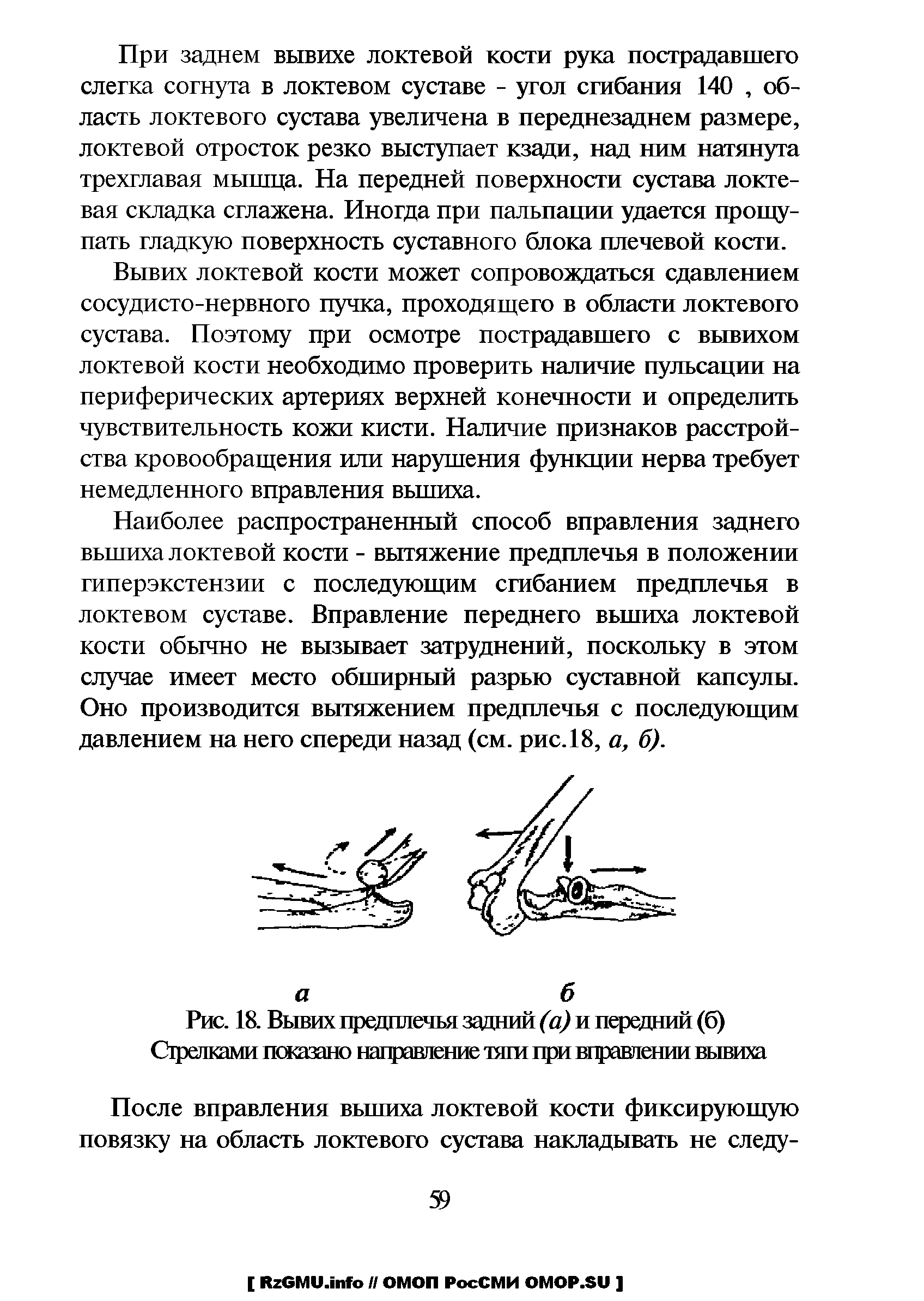 Рис. 18. Вывих предплечья задний (а) и передний (б) Стрелками показано направление тяги при вправлении вывиха...