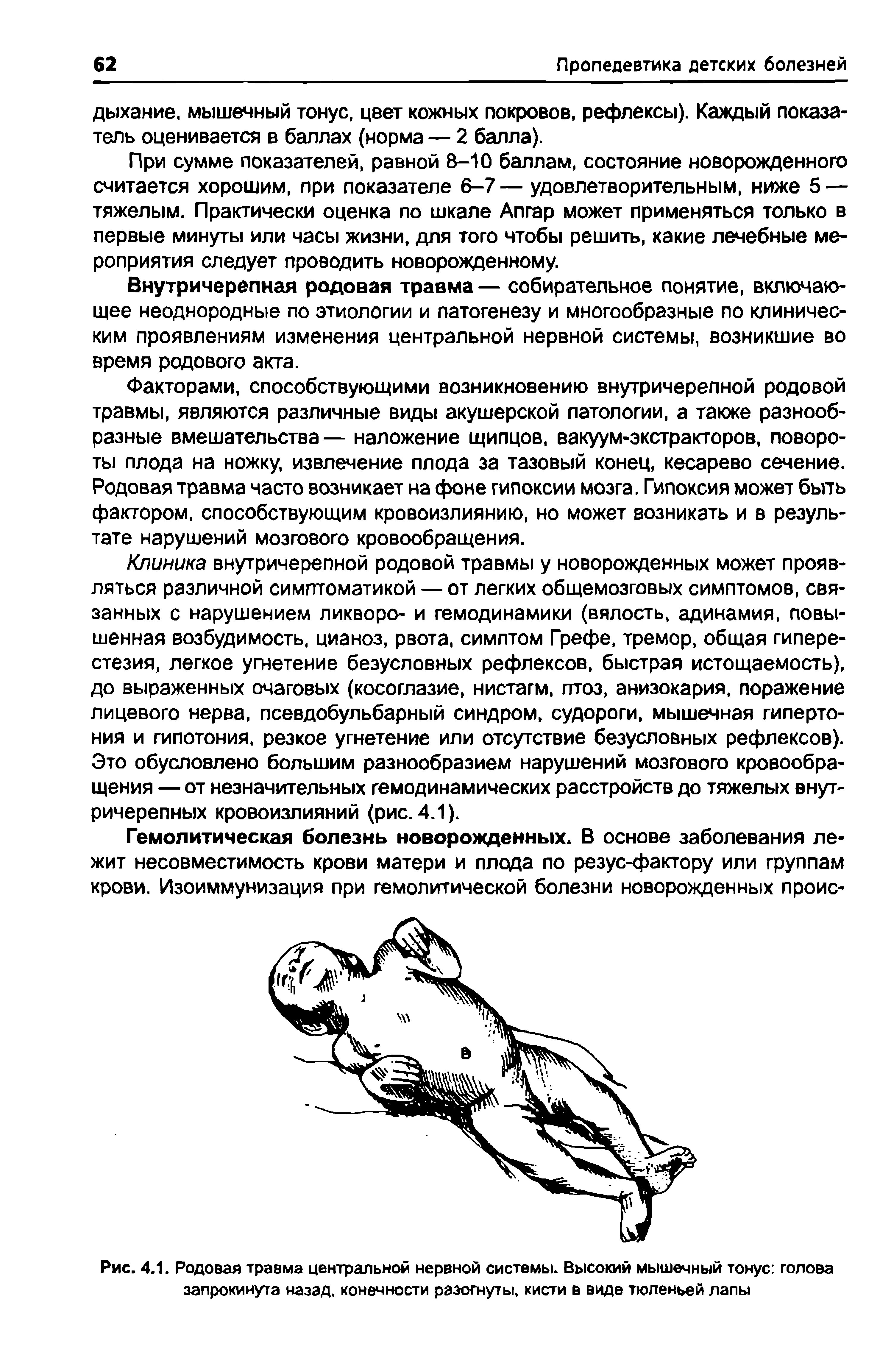 Рис. 4.1. Родовая травма центральной нервной системы. Высокий мышечный тонус голова запрокинута назад, конечности разогнуты, кисти в виде тюленьей лапы...