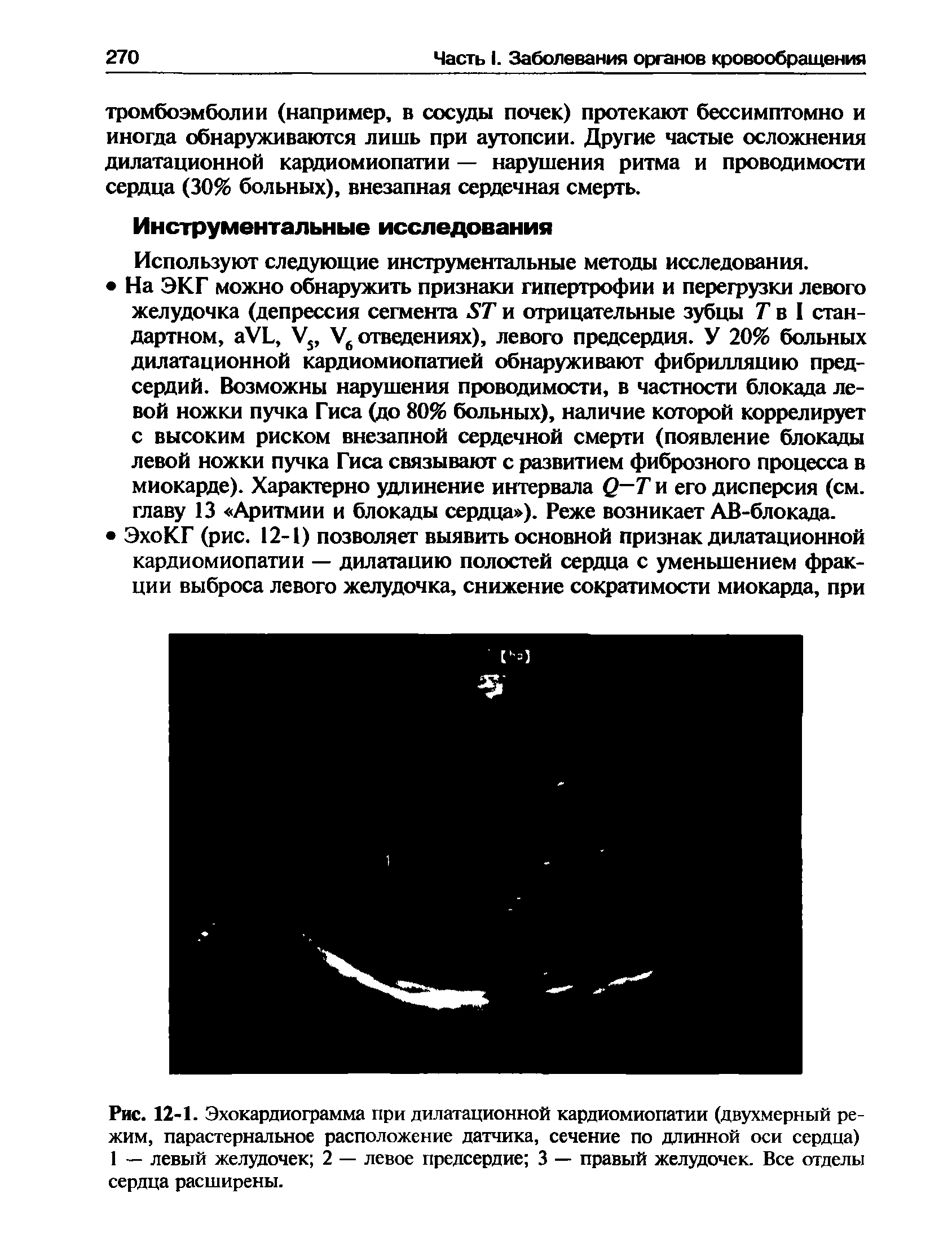 Рис. 12-1. Эхокардиограмма при дилатационной кардиомиопатии (двухмерный режим, парастернальное расположение датчика, сечение по длинной оси сердца) 1 — левый желудочек 2 — левое предсердие 3 — правый желудочек. Все отделы сердца расширены.