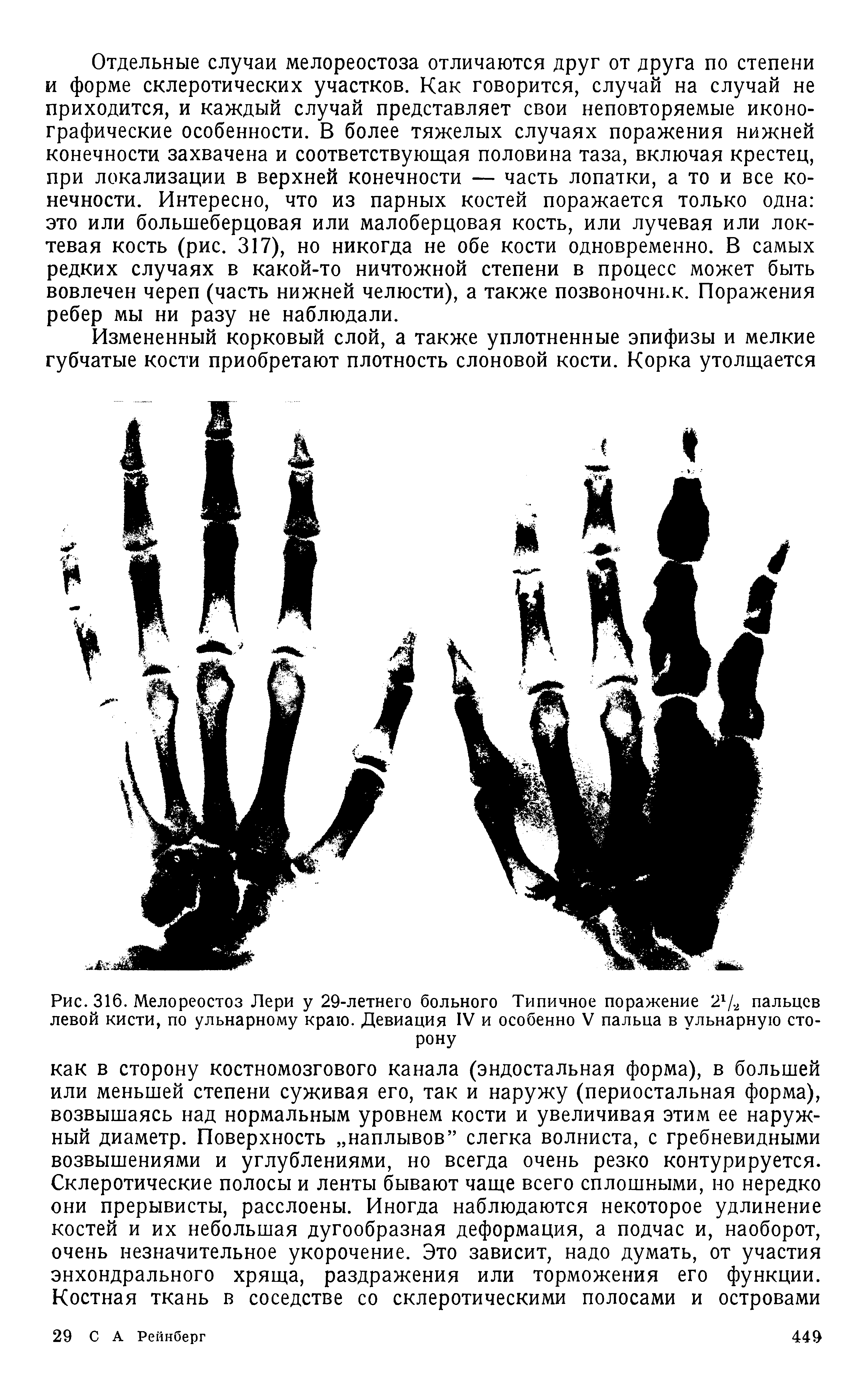 Рис. 316. Мелореостоз Лери у 29-летнего больного Типичное поражение 21/. пальцев левой кисти, по ульнарному краю. Девиация IV и особенно V пальца в ульнарную сторону...