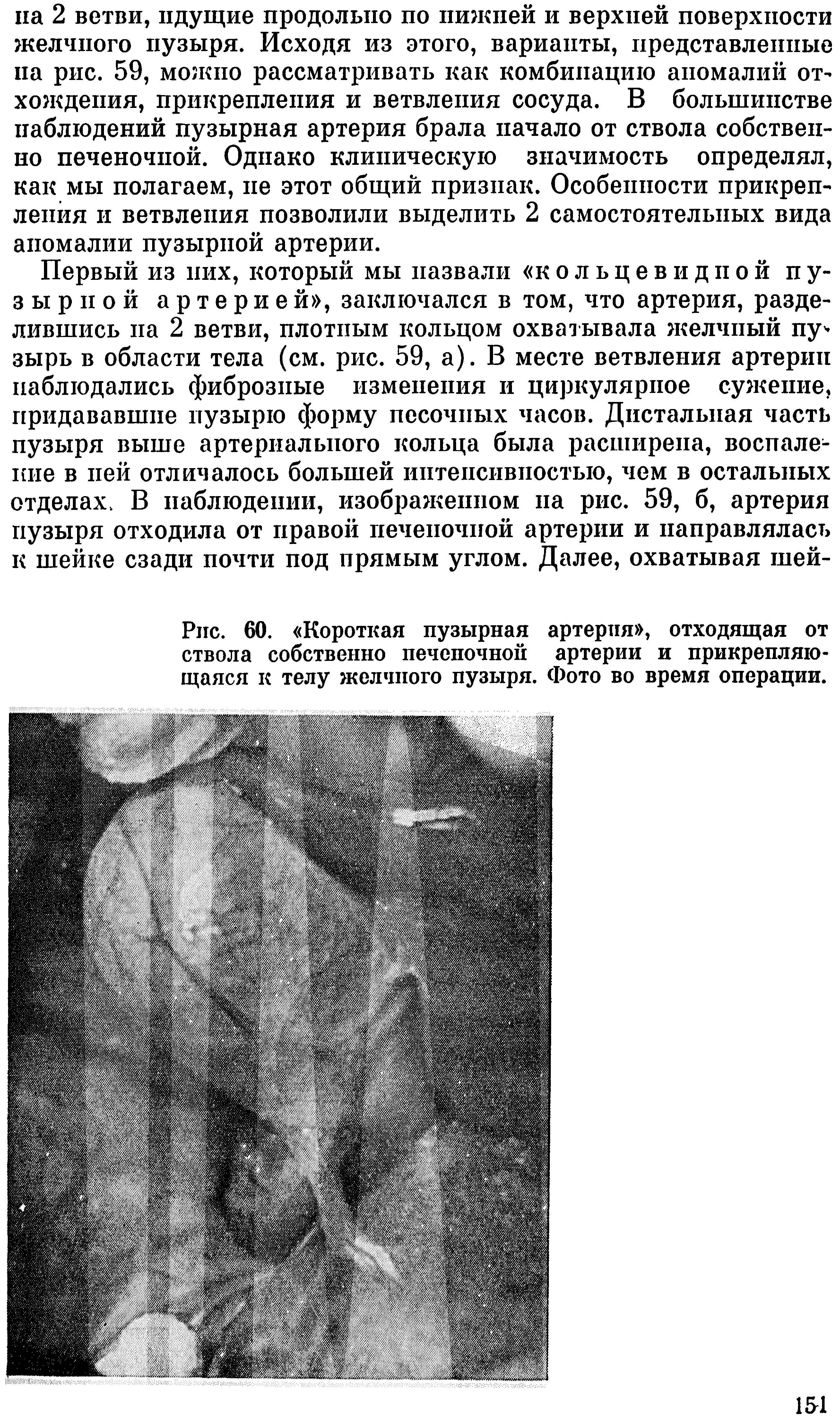 Рис. 60. Короткая пузырная артерия , отходящая от ствола собственно печеночной артерии и прикрепляющаяся к телу желчного пузыря. Фото во время операции.