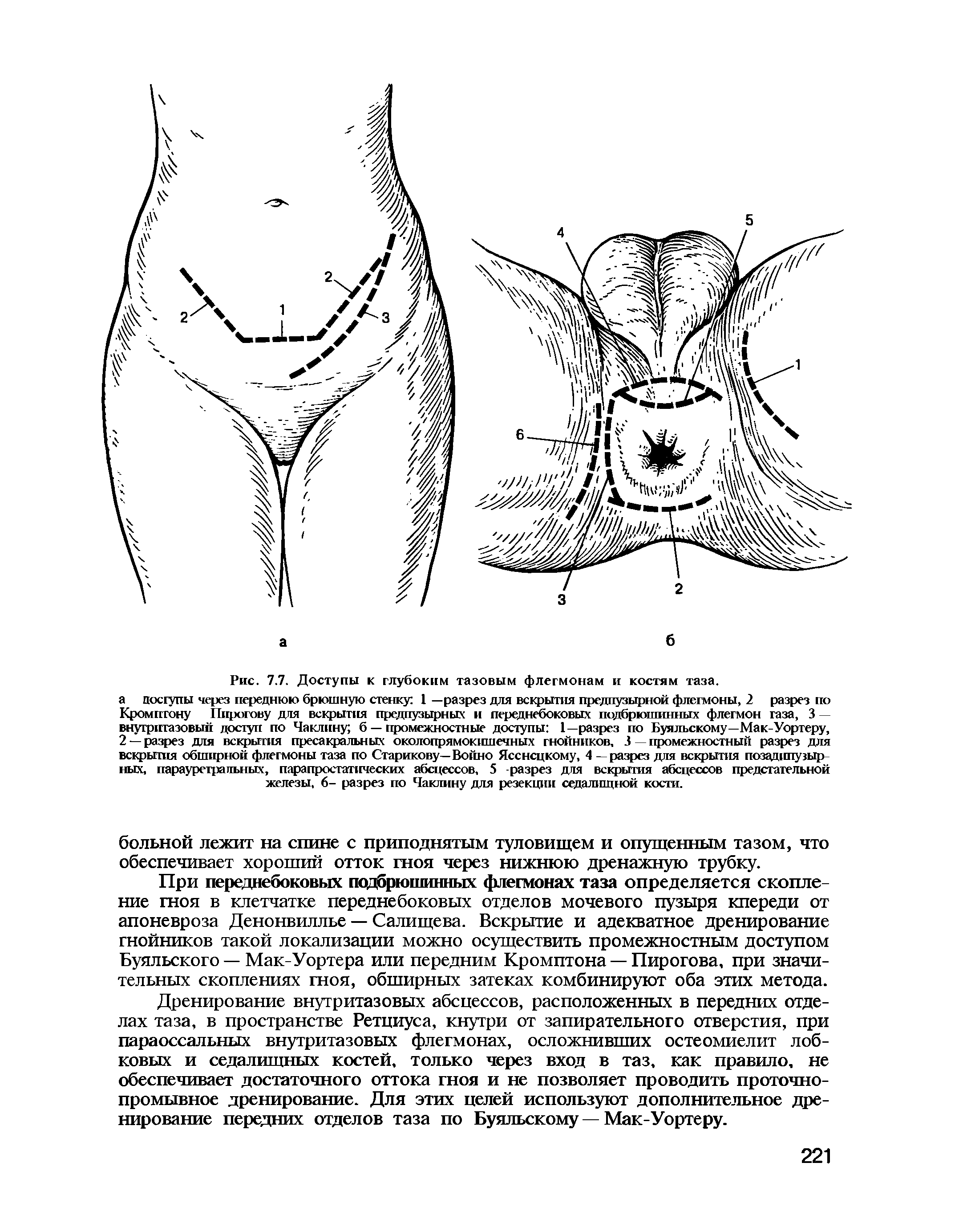 Рис. 7.7. Доступы к глубоким тазовым флегмонам и костям таза.